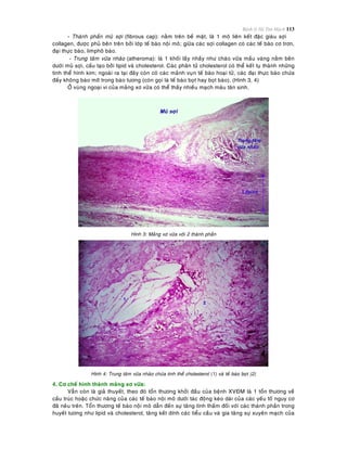 Bệnh lý Hệ Tim Mạch 113
- Thaønh phaàn muõ sôïi (fibrous cap): naèm treân beà maët, laø 1 moâ lieân keát ñaëc giaøu sôïi
collagen, ñöôïc phuû beân treân bôûi lôùp teá baøo noäi moâ; giöõa caùc sôïi collagen coù caùc teá baøo cô trôn,
ñaïi thöïc baøo, limphoâ baøo.
- Trung taâm vöõa nhaõo (atheroma): laø 1 khoái laày nhaày nhö chaùo vöõa maàu vaøng naèm beân
döôùi muõ sôïi, caáu taïo bôûi lipid vaø cholesterol. Caùc phaân töû cholesterol coù theå keát tuï thaønh nhöõng
tinh theå hình kim; ngoaøi ra taïi ñaây coøn coù caùc maûnh vuïn teá baøo hoaïi töû, caùc ñaïi thöïc baøo chöùa
ñaày khoâng baøo môõ trong baøo töông (coøn goïi laø teá baøo boït hay boït baøo). (Hình 3, 4)
ÔÛ vuøng ngoaïi vi cuûa maûng xô vöõa coù theå thaáy nhieàu maïch maùu taân sinh.
Hình 3: Maûng xô vöõa vôùi 2 thaønh phaàn
Hình 4: Trung taâm vöõa nhaõo chöùa tinh theå cholesterol (1) vaø teá baøo boït (2)
4. Cô cheá hình thaønh maûng xô vöõa:
Vaãn coøn laø giaû thuyeát, theo ñoù toån thöông khôûi ñaàu cuûa beänh XVÑM laø 1 toån thöông veà
caáu truùc hoaëc chöùc naêng cuûa caùc teá baøo noäi moâ döôùi taùc ñoäng keùo daøi cuûa caùc yeáu toá nguy cô
ñaõ neâu treân. Toån thöông teá baøo noäi moâ daãn ñeán söï taêng tính thaám ñoái vôùi caùc thaønh phaàn trong
huyeát töông nhö lipid vaø cholesterol, taêng keát dính caùc tieåu caàu vaø gia taêng söï xuyeân maïch cuûa
 