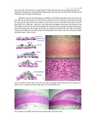 Bệnh lý Hệ Tim Mạch 114
caùc mono baøo. Keát quaû laø coù söï gia taêng soá löôïng ñaïi thöïc baøo vaø söï laéng ñoïng lipid vaø
cholesterol trong lôùp aùo trong cuûa thaønh ñoäng maïch. Caùc ñaïi thöïc baøo bieán thaønh teá baøo boït do
nhaäp baøo quaù möùc lipid vaø cholesterol.
Maët khaùc, caùc yeáu toá taêng tröôûng nhö PDGF vaø TGF beâta; ñöôïc tieát ra bôûi caùc teá baøo noäi
moâ, tieåu caàu vaø ñaïi thöïc baøo; seõ kích thích caùc teá baøo cô trôn di chuyeån töø lôùp aùo giöõa vaøo lôùp
aùo trong vaø tieán haønh phaân baøo taïi ñaây. Caùc teá baøo cô trôn seõ thay ñoåi töø kieåu hình "co duoãi"
thaønh kieåu hình "toång hôïp - taêng sinh", saûn xuaát caùc sôïi collagen vaø sôïi chun, taïo thaønh muõ sôïi
cuûa maûng xô vöõa. Muõ sôïi caûn trôû söï khuyeách taùn cuûa oxy vaø caùc chaát dinh döôõng töø loøng maïch
vaøo lôùp aùo trong, laøm caùc teá baøo boït bò hoaïi töû, keát quaû hình thaønh khoái vöõa nhaõo ôû trung taâm
maûng xô vöõa. Maûng xô vöõa cheøn eùp phaù vôõ maøng ngaên chun trong vaø laøm teo moûng lôùp aùo giöõa
cuûa thaønh maïch. (Hình 5 vaø 6)
Hình 5: Cô cheá hình thaønh maûng xô vöõa (A), caùc teá baøo öù ñoïng lipid (*) taäp trung trong lôùp aùo trong (B), caùc
teá baøo cô trôn di chuyeån vaøo lôùp aùo trong, taêng sinh vaø thay ñoåi kieåu hình
Hình 6: Maûng xô vöõa (MXV) cheøn eùp laøm teo moûng aùo giöõa (AG) thaønh maïch.
 
