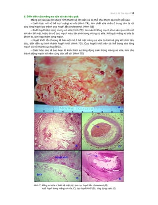 Bệnh lý Hệ Tim Mạch 115
5. Dieãn tieán cuûa maûng xô vöõa vaø caùc haäu quaû:
Maûng xô vöõa sau khi ñöôïc hình thaønh seõ lôùn daàn vaø coù theå chòu theâm caùc bieán ñoåi sau:
- Loeùt hoaëc nöùt vôõ beà maët maûng xô vöõa (Hình 7A), laøm chaát vöõa nhaõo ôû trung taâm bò rôùt
vaøo loøng maïch taïo thaønh cuïc huyeát taéc cholesterol. (Hình 7B)
- Xuaát huyeát beân trong maûng xô vöõa (Hình 7C): do maùu töø loøng maïch chui vaøo qua choã nöùt
vôõ treân beà maët, hoaëc do vôõ caùc maïch maùu taân sinh trong maûng xô vöõa. Keát quaû maûng xô vöõa bò
phình to, laøm heïp theâm loøng maïch.
- Huyeát khoái: toån thöông teá baøo noäi moâ ôû beà maët maûng xô vöõa do loeùt seõ gaây keát dính tieåu
caàu, daãn ñeán söï hình thaønh huyeát khoái (Hình 7D). Cuïc huyeát khoái naøy coù theå bong vaøo loøng
maïch vaø trôû thaønh cuïc huyeát taéc.
- Calci hoùa: caùc teá baøo hoaïi töû kích thích söï laéng ñoïng calci trong maûng xô vöõa, laøm cho
thaønh ñoäng maïch trôû neân cöùng doøn deã vôõ. (Hình 7E)
Hình 7: Maûng xô vöõa bò loeùt beà maët (A), taïo cuïc huyeát taéc cholesterol (B),
xuaát huyeát trong maûng xô vöõa (C), taïo huyeát khoái (D), laéng ñoïng calci (E)
 