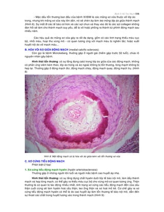 Bệnh lý Hệ Tim Mạch 116
- Maëc daàu toån thöông ban ñaàu cuûa beänh XVÑM laø caùc maûng xô vöõa thuoäc veà lôùp aùo
trong, nhöng khi maûng xô vöõa naøy lôùn daàn, noù seõ cheøn eùp laøm teo moûng lôùp aùo giöõa thaønh maïch
(Hình 6). Söï maát ñi caùc teá baøo cô trôn vaø caùc sôïi chun vaø thay vaøo ñoù laø caùc sôïi collagen khoâng
ñaøn hoài seõ laøm cho thaønh maïch suy yeáu, deã bò vôõ hoaëc phoàng ra thaønh tuùi phình ñoäng maïch sau
nhieàu naêm.
Caùc haäu quaû do maûng xô vöõa gaây ra raát ña daïng, goàm coù caùc tình traïng thieáu maùu cuïc
boä, nhoài maùu, hoaïi thö vuøng moâ - cô quan töông öùng vôùi maïch maùu bò ngheõn taéc; hoaëc xuaát
huyeát noäi do vôõ maïch maùu...
B. HOÙA VOÂI AÙO GIÖÕA ÑOÄNG MAÏCH (medial calcific sclerosis):
Coøn goïi laø beänh Monckeberg, thöôøng gaëp ôû ngöôøi giaø (hieám gaëp tröôùc 50 tuoåi), chöa roõ
nguyeân nhaân gaây beänh.
Hình thaùi toån thöông: coù söï laéng ñoïng calci trong lôùp aùo giöõa cuûa caùc ñoäng maïch, khoâng
coù phaûn öùng vieâm keøm theo, lôùp aùo trong vaø aùo ngoaøi khoâng bò toån thöông, loøng maïch khoâng bò
heïp laïi. Thöôøng gaëp ôû ñoäng maïch ñuøi, ñoäng maïch chaøy, ñoäng maïch quay, ñoäng maïch truï. (Hình
8)
Hình 8: Moät ñoäng maïch cô bò hoùa voâi aùo giöõa keøm vôùi toån thöông xô vöõa
C. XÔ CÖÙNG TIEÅU ÑOÄNG MAÏCH
Phaân bieät 2 loaïi:
1. Xô cöùng tieåu ñoäng maïch hyalin (hyalin arteriolosclerosis):
Thöôøng gaëp ôû nhöõng ngöôøi lôùn tuoåi vaø ngöôøi maéc beänh cao huyeát aùp nheï.
Hình thaùi toån thöông: coù söï laéng ñoïng chaát hyalin döôùi lôùp teá baøo noäi moâ, laøm daày thaønh
maïch vaø heïp loøng maïch, coù theå gaây ra thieáu maùu cuïc boä cho vuøng moâ-cô quan töông öùng. Thaän
thöôøng laø cô quan bò taùc ñoäng nhieàu nhaát, tình traïng xô cöùng caùc tieåu ñoäng maïch ñeán cuûa caàu
thaän cuoái cuøng seõ laøm hyalin hoaù caàu thaän, teo oáng thaän vaø xô hoaù moâ keõ. Cô cheá gaây ra xô
cöùng tieåu ñoäng maïch hyalin coù theå laø do cao huyeát aùp laøm toån thöông teá baøo noäi moâ, daãn ñeán
söï thoaùt caùc chaát trong huyeát töông vaøo trong thaønh maïch (Hình 9).
 