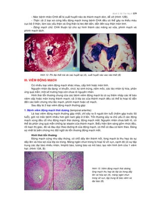 Bệnh lý Hệ Tim Mạch 119
- Naõo: beänh nhaân CHA deã bò xuaát huyeát naõo do thaønh maïch doøn, deã vôõ (Hình 12B).
- Thaän: caû 2 loaïi xô cöùng tieåu ñoäng maïch trong beänh CHA ñeàu coù theå gaây ra thieáu maùu
cuïc boä ôû thaän, laøm caùc caàu thaän vaø oáng thaän bò teo ñeùt daàn, daãn ñeán suy thaän maõn tính.
- Ñoäng maïch chuû: CHA thuaän lôïi cho söï hình thaønh caùc maûng xô vöõa, phình maïch vaø
phình maïch taùch.
Hình 12: Phì ñaïi thaát traùi do cao huyeát aùp (A), xuaát huyeát naõo vaøo naõo thaát (B)
III. VIEÂM ÑOÄNG MAÏCH
Coù nhieàu loaïi vieâm ñoäng maïch khaùc nhau, caáp tính hoaëc maõn tính.
Nguyeân nhaân ña daïng: vi khuaån, viruùt, kyù sinh truøng, naám moác, caùc taùc nhaân lyù hoùa, phaûn
öùng quaù maãn; moät soá tröôøng hôïp coøn chöa roõ nguyeân nhaân.
Hình thaùi toån thöông chung cuûa caùc beänh vieâm ñoäng maïch laø coù söï thaám nhaäp caùc teá baøo
vieâm caáp hoaëc maõn trong thaønh maïch; caû 3 lôùp aùo cuûa thaønh maïch ñeàu coù theå bò hoaïi töû daãn
ñeán caùc bieán chöùng nhö taéc maïch, phình maïch hoaëc vôõ maïch.
Sau ñaây laø 2 loaïi vieâm ñoäng maïch thöôøng gaëp:
1. Beänh vieâm ñoäng maïch thaùi döông (temporal arteritis):
Laø loaïi vieâm ñoäng maïch thöôøng gaëp nhaát, chæ xaûy ra ôû ngöôøi lôùn tuoåi (hieám gaëp tröôùc 50
tuoåi), giôùi nöõ maéc beänh nhieàu hôn giôùi nam gaáp 2-3 laàn. Toån thöông xaûy ra chuû yeáu ôû caùc ñoäng
maïch vuøng ñaàu coå nhö ñoäng maïch thaùi döông, ñoäng maïch maét. Nguyeân nhaân chöa bieát roõ, coù
theå do phaûn öùng quaù maãn choáng laïi elastin cuûa thaønh maïch. Bieåu hieän laâm saøng goàm nhöùc ñaàu,
roái loaïn thò giaùc, ñoû vaø ñau doïc theo ñöôøng ñi cuûa ñoäng maïch, coù theå coù ñau cô keøm theo. Ñaùng
sôï nhaát laø bieán chöùng muø ñoät ngoät do toån thöông ñoäng maïch maét.
Hình thaùi toån thöông:
Ñoäng maïch cöùng nhö daây thöøng, coù choã daày leân thaønh noát, loøng maïch bò thu heïp do söï
daày leân vaø hoùa sôïi cuûa lôùp aùo trong. Maøng ngaên chun trong bò hoaïi töû vôõ vuïn, caïnh ñoù coù söï taäp
trung caùc ñaïi baøo nhieàu nhaân, limphoâ baøo, töông baøo vaø moâ baøo; taïo neân hình aûnh cuûa 1 vieâm
haït. (Hình 13A, B)
Hình 13: Vieâm ñoäng maïch thaùi döông,
loøng maïch thu heïp do lôùp aùo trong daày
leân vaø hoùa sôïi (A), maøng ngaên chun
trong vôõ vuïn, taäp trung teá baøo vieâm vaø
ñaïi baøo (B).
 