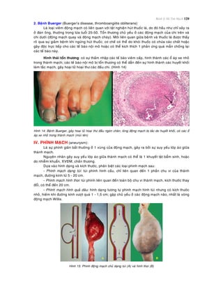 Bệnh lý Hệ Tim Mạch 120
2. Beänh Buerger (Buerger’s disease, thromboangiitis obliterans)
Laø loaïi vieâm ñoäng maïch coù lieân quan vôùi taät nghieän huùt thuoác laù, do ñoù haàu nhö chæ xaûy ra
ôû ñaøn oâng, thöôøng trong löùa tuoåi 25-50. Toån thöông chuû yeáu ôû caùc ñoäng maïch cuûa chi treân vaø
chi döôùi (ñoäng maïch quay vaø ñoäng maïch chaøy). Moái lieân quan giöõa beänh vaø thuoác laù ñöôïc thaáy
roõ qua söï giaûm beänh khi ngöøng huùt thuoác; cô cheá coù theå do khoùi thuoác coù chöùa caùc chaát hoaëc
gaây ñoäc tröïc tieáp cho caùc teá baøo noäi moâ hoaëc coù theå kích thích 1 phaûn öùng quaù maãn choáng laïi
caùc teá baøo naøy.
Hình thaùi toån thöông: coù söï thaám nhaäp caùc teá baøo vieâm caáp, hình thaønh caùc oå aùp xe nhoû
trong thaønh maïch; caùc teá baøo noäi moâ bò toån thöông coù theå daãn ñeán söï hình thaønh caùc huyeát khoái
laøm taéc maïch, gaây hoaïi töû hoaïi thö caùc ñaàu chi. (Hình 14)
Hình 14: Beänh Buerger, gaây hoaïi töû hoaïi thö ñaàu ngoùn chaân; loøng ñoäng maïch bò taéc do huyeát khoái, coù caùc oå
aùp xe nhoû trong thaønh maïch (muõi teân)
IV. PHÌNH MAÏCH (aneurysm):
Laø söï phình giaõn baát thöôøng ôû 1 vuøng cuûa ñoäng maïch, gaây ra bôûi söï suy yeáu lôùp aùo giöõa
thaønh maïch.
Nguyeân nhaân gaây suy yeáu lôùp aùo giöõa thaønh maïch coù theå laø 1 khuyeát taät baåm sinh, hoaëc
do nhieãm khuaån, XVÑM, chaán thöông.
Döïa vaøo hình daïng vaø kích thöôùc, phaân bieät caùc loaïi phình maïch sau:
- Phình maïch daïng tuùi: tuùi phình hình caàu, chæ lieân quan ñeán 1 phaàn chu vi cuûa thaønh
maïch, ñöôøng kính töø 5 - 20 cm.
- Phình maïch hình thoi: tuùi phình lieân quan ñeán toaøn boä chu vi thaønh maïch, kích thöôùc thay
ñoåi, coù theå ñeán 20 cm.
- Phình maïch hình quaû daâu: hình daïng töông töï phình maïch hình tuùi nhöng coù kích thöôùc
nhoû, hieám khi ñöôøng kính vöôït quaù 1 - 1,5 cm; gaëp chuû yeáu ôû caùc ñoäng maïch naõo, nhaát laø voøng
ñoäng maïch Willis.
Hình 15: Phình ñoäng maïch chuû daïng tuùi (A) vaø hình thoi (B)
 