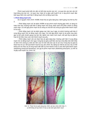Bệnh lý Hệ Tim Mạch 121
Phình maïch phaùt trieån lôùn daàn coù theå cheøn eùp leân caùc moâ - cô quan laân caän laøm caûn trôû
hoaït ñoäng cuûa caùc moâ - cô quan naøy, hoaëc vôõ ra gaây xuaát huyeát oà aït; vì vaäy phình maïch ñaëc
bieät nguy hieåm neáu xuaát hieän ôû ñoäng maïch chuû vaø ñoäng maïch naõo.
1. Phình ñoäng maïch chuû:
Do 3 nguyeân nhaân chính: XVÑM, thoaùi hoùa aùo giöõa daïng boïc, beänh giang mai thôøi kyø thöù
3.
- Phình ñoäng maïch chuû do beänh XVÑM: laø loaïi phình maïch thöôøng gaëp nhaát, coù daïng tuùi
hoaëc hình thoi, thöôøng xuaát hieän ôû ñoäng maïch chuû buïng, ñoaïn döôùi choã phaân nhaùnh ra ñoäng
maïch thaän. Cô cheá gaây phình maïch laø do maûng xô vöõa laøm teo moûng aùo giöõa khieán thaønh maïch
bò suy yeáu.
- Phình ñoäng maïch chuû do beänh giang mai: hieän nay ít gaëp, tuùi phình thöôøng xuaát hieän ôû
cung ñoäng maïch chuû vaø ñoäng maïch chuû ngöïc. Cô cheá gaây phình maïch laø do phaûn öùng vieâm
gaây ra bôûi xoaén khuaån giang mai laøm taéc ngheõn caùc maïch nuoâi maïch, keát quaû lôùp aùo giöõa bò
hoaïi töû do thieáu maùu nuoâi, laøm thaønh maïch suy yeáu.
- Phình ñoäng maïch chuû do thoaùi hoùa aùo giöõa daïng boïc: thöôøng xuaát hieän ôû cung ñoäng
maïch chuû vaø ñoäng maïch chuû ngöïc; trong lôùp aùo giöõa xuaát hieän caùc boïc chöùa ñaày moät chaát nhaày
voâ ñònh hình (töông töï chaát caên baûn cuûa moâ lieân keát) laøm caùc laù sôïi chun trong lôùp aùo giöõa bò
thoaùi hoùa vôõ vuïn; keát quaû thaønh maïch bò suy yeáu (Hình 16). Ñaùng sôï nhaát laø caùc boïc naøy coù theå
thoâng noái vôùi nhau vaø vôùi loøng maïch daãn ñeán söï hình thaønh oå maùu tuï boùc taùch giöõa thaønh maïch
(dissecting intramural hematoma), coøn goïi laø phình maïch taùch (dissecting aneurysm), coù theå vôõ
ra gaây xuaát huyeát oà aït. (Hình 16)
Hình 16: Thoaùi hoùa aùo giöõa daïng boïc (A,B), caùc boïc chöùa chaát nhaày (*);
coù theå thoâng noái taïo thaønh oå maùu tuï boùc taùch giöõa thaønh maïch.
 