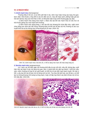 Bệnh lý Hệ Tim Mạch 123
VI. U MAÏCH MAÙU
1. U laønh maïch maùu (hemangioma):
Thöôøng thaáy ôû treû em. U coù theå xuaát hieän ôû da, nieâm maïc hoaëc trong caùc taïng nhö gan,
laùch, thaän. Kích thöôùc u thay ñoåi töø vaøi mm ñeán vaøi cm, maøu ñoû hoaëc xanh, phaúng hoaëc goà cao
hôn beà maët da. Döïa vaøo hình thaùi vi theå, coù theå phaân bieät 2 loaïi chính thöôøng gaëp sau ñaây:
- U laønh maïch maùu daïng mao maïch: u ñöôïc caáu taïo bôûi caùc maïch maùu coù caáu truùc vaø
kích thöôùc gioáng caùc mao maïch bình thöôøng.
- U laønh maïch maùu daïng hang: u caáu taïo bôûi caùc khoang lôùn chöùa ñaày maùu, ngaên caùch
nhau baèng caùc vaùch lieân keát moûng. Khoang ñöôïc loùt bôûi caùc teá baøo noäi moâ; thöôøng coù caùc cuïc
huyeát khoái do söï löu thoâng maùu trong khoang bò roái loaïn. (Hình 19)
Hình 19: U laønh maïch maùu ôû da traùn (A), vi theå coù daïng mao maïch (B) hoaëc daïng hang (C)
2. Sarcoâm maïch maùu (angiosarcoma):
Laø 1 loaïi u aùc raát hieám gaëp, toån thöông khôûi ñaàu laø caùc noát nhoû, maàu ñoû, khoâng ñau; xuaát
hieän treân da hoaëc ôû caùc noäi taïng nhö gan, laùch. U phaùt trieån lôùn daàn taïo thaønh 1 khoái lôùn maàu
xaùm, meàm; thöôøng coù hoaïi töû vaø xuaát huyeát, coù theå cho di caên ñeán haïch baïch huyeát. Veà maët vi
theå, u caáu taïo bôûi caùc teá baøo noäi moâ taêng sinh aùc tính. Tuøy theo ñoä bieät hoaù, caùc teá baøo u coù theå
taïo ra nhöõng khoang nhoû töông töï loøng maïch, hoaëc chæ taäp hôïp thaønh caùc ñaùm teá baøo noäi moâ aùc
tính daày ñaëc. (Hình 20)
Hình 20: Sarcoâm maïch maùu treân da vuù (A); Vi theå chi thaáy caùc teá baøo noäi moâ dò daïng (muõi teân, B).
 