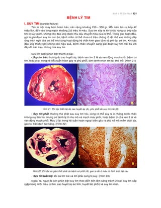 Bệnh lý Hệ Tim Mạch 124
BEÄNH LYÙ TIM
I. SUY TIM (cardiac failure)
Tim laø moät maùy bôm hoaøn haûo, caân naëng khoaûng 250 - 350 gr. Moãi naêm tim co boùp 42
trieäu laàn, ñaåy vaøo loøng maïch khoaûng 2,6 trieäu lít maùu. Suy tim xaûy ra khi chöùc naêng co boùp cuûa
tim bò suy giaûm, khoâng coøn ñaùp öùng ñöôïc nhu caàu chuyeån hoùa cuûa cô theå. Trong giai ñoaïn ñaàu,
goïi laø giai ñoaïn suy tim coøn buø, beänh nhaân coù theå chöa coù trieäu chöùng roõ reät nhôø vaøo nhöõng ñaùp
öùng thích nghi cuûa cô theå nhö taêng hoaït ñoäng heä thaàn kinh giao caûm vaø phì ñaïi cô tim. Khi caùc
ñaùp öùng thích nghi khoâng coøn hieäu quaû, beänh nhaân chuyeån sang giai ñoaïn suy tim maát buø vôùi
ñaày ñuû caùc trieäu chöùng cuûa suy tim.
Suy tim ñöôïc phaân bieät thaønh 3 loaïi:
- Suy tim traùi: thöôøng do cao huyeát aùp, beänh van tim 2 laù vaø van ñoäng maïch chuû, beänh cô
tim. Maùu öù laïi trong heä tieåu tuaàn hoaøn gaây ra phuø phoåi, laøm beänh nhaân tím taùi khoù thôû. (Hình 21)
Hình 21: Phì ñaïi thaát traùi do cao huyeát aùp (A), phuø phoåi do suy tim traùi (B)
- Suy tim phaûi: thöôøng thöù phaùt sau suy tim traùi, cuõng coù theå xaûy ra ôû nhöõng beänh nhaân
khoâng suy tim traùi nhöng coù beänh lyù ôû nhu moâ vaø maïch maùu phoåi, hoaëc beänh lyù cuûa van 3 laù vaø
van ñoäng maïch phoåi. Maùu öù laïi trong heä tuaàn hoaøn ngoaïi bieân gaây ra phuø neà moâ meàm döôùi da,
gan to, traøn dòch ña maøng. (Hình 22)
Hình 22: Phì ñaïi vaø giaõn thaát phaûi do beänh xô phoåi (A), gan to do öù maùu coù hình aûnh haït cau
- Suy tim toaøn boä: khi caû tim traùi vaø tim phaûi cuøng bò suy. (Hình 23)
Ngoaøi ra, ngöôøi ta coøn phaân bieät suy tim theo dieãn tieán laâm saøng thaønh 2 loaïi: suy tim caáp
(gaëp trong nhoài maùu cô tim, cao huyeát aùp aùc tính, huyeát taéc phoåi) vaø suy tim maõn.
 