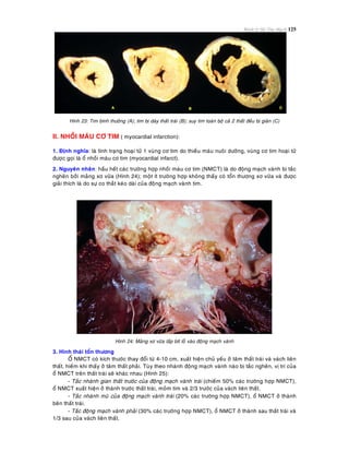 Bệnh lý Hệ Tim Mạch 125
Hình 23: Tim bình thöôøng (A); tim bò daøy thaát traùi (B); suy tim toaøn boä caû 2 thaát ñeàu bò giaõn (C)
II. NHOÀI MAÙU CÔ TIM ( myocardial infarction):
1. Ñònh nghóa: laø tình traïng hoaïi töû 1 vuøng cô tim do thieáu maùu nuoâi döôõng, vuøng cô tim hoaïi töû
ñöôïc goïi laø oå nhoài maùu cô tim (myocardial infarct).
2. Nguyeân nhaân: haàu heát caùc tröôøng hôïp nhoài maùu cô tim (NMCT) laø do ñoäng maïch vaønh bò taéc
ngheõn bôûi maûng xô vöõa (Hình 24); moät ít tröôøng hôïp khoâng thaáy coù toån thöông xô vöõa vaø ñöôïc
giaûi thích laø do söï co thaét keùo daøi cuûa ñoäng maïch vaønh tim.
Hình 24: Maûng xô vöõa laáp bít loã vaøo ñoäng maïch vaønh
3. Hình thaùi toån thöông
OÅ NMCT coù kích thöôùc thay ñoåi töø 4-10 cm, xuaát hieän chuû yeáu ôû taâm thaát traùi vaø vaùch lieân
thaát, hieám khi thaáy ôû taâm thaát phaûi. Tuøy theo nhaùnh ñoäng maïch vaønh naøo bò taéc ngheõn, vò trí cuûa
oå NMCT treân thaát traùi seõ khaùc nhau (Hình 25):
- Taéc nhaùnh gian thaát tröôùc cuûa ñoäng maïch vaønh traùi (chieám 50% caùc tröôøng hôïp NMCT),
oå NMCT xuaát hieän ôû thaønh tröôùc thaát traùi, moûm tim vaø 2/3 tröôùc cuûa vaùch lieân thaát.
- Taéc nhaùnh muõ cuûa ñoäng maïch vaønh traùi (20% caùc tröôøng hôïp NMCT), oå NMCT ôû thaønh
beân thaát traùi.
- Taéc ñoäng maïch vaønh phaûi (30% caùc tröôøng hôïp NMCT), oå NMCT ôû thaønh sau thaát traùi vaø
1/3 sau cuûa vaùch lieân thaát.
 