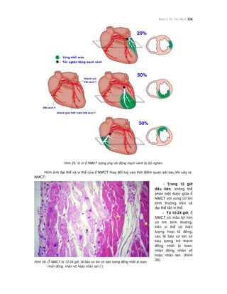 Bệnh lý Hệ Tim Mạch 126
Hình 25: Vò trí oå NMCT töông öùng vôùi ñoäng maïch vaønh bò taéc ngheõn.
Hình aûnh ñaïi theå vaø vi theå cuûa oå NMCT thay ñoåi tuyø vaøo thôøi ñieåm quan saùt sau khi xaûy ra
NMCT:
Hình 26: OÅ NMCT töø 12-24 giôø, teá baøo cô tim coù baøo töông ñoàng nhaát aùi toan,
nhaân ñoâng, nhaân vôõ hoaëc nhaân tan (*).
- Trong 12 giôø
ñaàu tieân, khoâng theå
phaân bieät ñöôïc giöõa oå
NMCT vôùi vuøng cô tim
bình thöôøng treân caû
ñaïi theå laãn vi theå.
- Töø 12-24 giôø, oå
NMCT coù maàu lôït hôn
cô tim bình thöôøng;
treân vi theå coù hieän
töôïng hoaïi töû ñoâng,
caùc teá baøo cô tim coù
baøo töông trôû thaønh
ñoàng nhaát aùi toan,
nhaân ñoâng, nhaân vôõ
hoaëc nhaân tan. (Hình
26)
 
