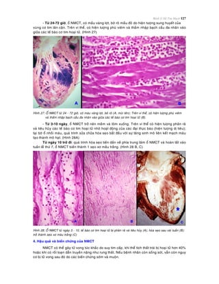 Bệnh lý Hệ Tim Mạch 127
- Töø 24-72 giôø, oå NMCT, coù maàu vaøng lôït, bôø roõ maàu ñoû do hieän töôïng sung huyeát cuûa
vuøng cô tim laân caän. Treân vi theå, coù hieän töôïng phuø vieâm vaø thaám nhaäp baïch caàu ña nhaân vaøo
giöõa caùc teá baøo cô tim hoaïi töû. (Hình 27)
Hình 27: OÅ NMCT töø 24 - 72 giôø, coù maøu vaøng lôït, bôø roõ (A, muõi teân); Treân vi theå, coù hieän töôïng phuø vieâm
vaø thaám nhaäp baïch caàu ña nhaân vaøo giöõa caùc teá baøo cô tim hoaïi töû (B).
- Töø 3-10 ngaøy, oå NMCT trôû neân meàm vaø loõm xuoáng. Treân vi theå coù hieän töôïng phaân raõ
vaø tieâu huûy caùc teá baøo cô tim hoaïi töû nhôø hoaït ñoäng cuûa caùc ñaïi thöïc baøo (hieän töôïng dò tieâu);
taïi bôø oå nhoài maùu, quaù trình söûa chöõa hoùa seïo baét ñaàu vôùi söï taêng sinh moâ lieân keát maïch maùu
taïo thaønh moâ haït. (Hình 28A)
Töø ngaøy 10 trôû ñi: quaù trình hoùa seïo tieán daàn veà phía trung taâm oå NMCT vaø hoaøn taát vaøo
tuaàn leã thöù 7, oå NMCT bieán thaønh 1 seïo xô maàu traéng. (Hình 28 B, C)
Hình 28: OÅ NMCT töø ngaøy 3 - 10, teá baøo cô tim hoaïi töû bò phaân raõ vaø tieâu huûy (A); hoùa seïo sau vaøi tuaàn (B);
trôû thaønh seïo xô maøu traéng (C)
4. Haäu quaû vaø bieán chöùng cuûa NMCT
NMCT coù theå gaây töû vong töùc khaéc do suy tim caáp, khi theå tích thaát traùi bò hoaïi töû hôn 40%
hoaëc khi coù roái loaïn daãn truyeàn naëng nhö rung thaát. Neáu beänh nhaân coøn soáng soùt, vaãn coøn nguy
cô bò töû vong sau ñoù do caùc bieán chöùng sôùm vaø muoän.
 