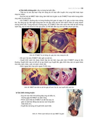 Bệnh lý Hệ Tim Mạch 128
a/ Caùc bieán chöùng sôùm: xaûy ra trong hai tuaàn ñaàu.
- Tieáp tuïc bò caùc ñôït loaïn nhòp tim naëng do roái loaïn daãn truyeàn nhö rung thaát hoaëc loaïn
nhòp tim chaäm.
- Suy tim traùi do NMCT dieän roäng, taâm thaát traùi bò giaõn ra do oå NMCT hoaù meàm trong phaûn
öùng vieâm vaø söûa chöõa.
- Vôõ oå NMCT, thöôøng xaûy ra trong khoaûng thôøi gian töø ngaøy 3-10, gaây ra traøn maùu maøng
tim. Söï taêng aùp löïc ñoät ngoät trong bao tim seõ gaây cheøn eùp tim laøm beänh nhaân töû vong nhanh
choùng (Hình 29). Trong moät soá ít tröôøng hôïp, vôõ oå NMCT naèm treân vaùch lieân thaát seõ laøm thuûng
vaùch naøy, taïo ra moät shunt töø traùi qua phaûi; coù theå daãn ñeán suy tim traùi neáu shunt quaù lôùn.
Hình 29: OÅ NMCT bò vôõ thuûng (A), gaây traøn maùu maøng tim (B).
- Hôû van 2 laù neáu oå NMCT naèm gaàn cô coät tim.
- Huyeát khoái vaùch tim ñöôïc thaønh laäp do noäi taâm maïc phuû treân oå NMCT cuõng bò toån
thöông. Huyeát khoái naøy coù theå vôõ ra taïo thaønh cuïc huyeát taéc, gaây nhoài maùu caùc cô quan khaùc
nhö naõo, laùch, thaän, ruoät, chi döôùi. (Hình 30)
- Vieâm ngoaïi taâm maïc phuû ngoaøi oå nhoài maùu.
Hình 30: NMCT laøm ñöùt cô coät tim gaây hôû van 2 laù (A), taïo huyeát khoái vaùch tim
b/ Caùc bieán chöùng muoän:
- Suy tim traùi maõn tính khoâng ñaùp öùng vôùi ñieàu trò,
thöôøng gaëp khi NMCT coù dieän roäng.
- Phình vaùch thaát do oå NMCT cuõ ñaõ hoaù seïo, bò
giaõn ra döôùi taùc ñoäng cuûa aùp löïc cao trong taâm
thaát (Hình 31).
- Huyeát taéc do bong vôõ huyeát khoái vaùch thaát.
Hình 31: Phình vaùch thaát do moâ seïo NMCT bò giaõn
 