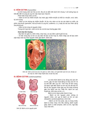 Bệnh lý Hệ Tim Mạch 129
II. VIEÂM CÔ TIM (myocarditis):
Laø tình traïng vieâm lan toûa cô tim. Ña soá coù dieãn tieán laønh tính nhöng 1 soá tröôøng hôïp coù
theå daãn ñeán töû vong do suy tim caáp hoaëc loaïn nhòp tim.
Phaân bieät 3 loaïi vieâm cô tim:
- Vieâm cô tim do nhieãm khuaån: taùc nhaân gaây nhieãm khuaån coù theå laø vi khuaån, viruùt, naám,
kyù sinh truøng.
- Vieâm cô tim khoâng do nhieãm khuaån: thí duï nhö vieâm cô tim do caùc beänh töï mieãn, do
phaûn öùng thuoác (penicillin, moät soá thuoác trò ung thö, sulfamid, v.v.), hoaëc do caùc taùc nhaân vaät lyù
(tia phoùng xaï).
- Vieâm cô tim chöa roõ nguyeân nhaân
Trong caû 3 loaïi treân, vieâm cô tim do viruùt laø loaïi thöôøng gaëp nhaát.
Hình thaùi toån thöông :
- Ñaïi theå: tim giaõn to, meàm nhaõo, nhaït maøu, coù caùc ñoám xuaát huyeát raûi raùc.
- Vi theå: trong lôùp cô tim coù caùc ñaùm teá baøo cô tim hoaïi töû, thaám nhaäp caùc teá baøo vieâm
caáp hoaëc maõn tuøy theo nguyeân nhaân gaây beänh. (Hình 32)
Hình 32: Vieâm cô tim do viruùt, tim giaõn to, meàm nhaõo, coù huyeát khoái vaùch tim (A), teá baøo cô
tim hoaïi töû, thaám nhaäp limphoâ baøo vaø ñaïi thöïc baøo
III. BEÄNH CÔ TIM (cardiomyopathies)
Hình 33: Beänh cô tim nguyeân phaùt
Laø moät nhoùm beänh lyù taùc ñoäng chuû yeáu leân
cô tim, gaây roái loaïn hoaït ñoäng co boùp cuûa tim vaø
coù theå daãn ñeán suy tim. Treân thöïc teá laâm saøng,
chæ ñöôïc nghó ñeán beänh cô tim sau khi ñaõ loaïi tröø
taát caû caùc nguyeân nhaân gaây suy tim khaùc thöôøng
gaëp nhö beänh van tim, thaáp tim, beänh tim cao
huyeát aùp, nhoài maùu cô tim, v.v.
Beänh cô tim ñöôïc phaân thaønh 2 loaïi:
- Beänh cô tim nguyeân phaùt, khoâng roõ
nguyeân nhaân, coøn goïi laø beänh cô tim voâ caên
(idiopathic cardiomyopathies). (hình 33)
- Beänh cô tim thöù phaùt, xaûy ra trong nhieàu
beänh lyù khaùc nhau nhö tieåu ñöôøng, beänh tuyeán
giaùp, beänh öù chaát amyloid, vieâm cô tim, ngoä ñoäc
röôïu maõn tính.
 