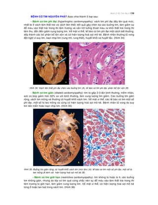 Bệnh lý Hệ Tim Mạch 130
BEÄNH CÔ TIM NGUYEÂN PHAÙT ñöôïc chia thaønh 3 loaïi sau:
- Beänh cô tim phì ñaïi (hypertrophic cardiomyopathy): vaùch tim phì ñaïi daày leân quaù möùc,
nhaát laø ôû vaùch taâm thaát traùi vaø vaùch lieân thaát; keát quaû gaây cheøn eùp caùc buoàng tim, laøm giaûm söï
ñoå maùu vaøo thaát traùi trong thì taâm tröông vaø caûn trôû luoàng thoaùt maùu ra khoûi thaát traùi trong thì
taâm thu, daãn ñeán giaûm cung löôïng tim. Veà maët vi theå, teá baøo cô tim phì ñaïi moät caùch baát thöôøng,
xeáp thaønh caùc boù phaân boá loän xoän vaø coù hieän töôïng hoaù sôïi moâ keõ. Beänh nhaân thöôøng töû vong
ñoät ngoät vì suy tim, loaïn nhòp tim (rung nhó, rung thaát), huyeát khoái vaø huyeát taéc. (Hình 34)
Hình 34: Vaùch lieân thaát phì ñaïi cheøn vaøo buoàng tim (A), teá baøo cô tim phì ñaïi, phaân boá loän xoän (B)
- Beänh cô tim giaõn (dilated cardiomyopathy): tim to gaáp 2-3 laàn bình thöôøng, meàm nhaõo,
söùc co boùp giaûm hôn 50% so vôùi bình thöôøng, laøm cung löôïng tim giaûm. Caùc buoàng tim giaõn
roäng, vaùch tim moûng vaø thöôøng coù huyeát khoái vaùch tim. Veà maët vi theå, caùc teá baøo cô tim moät soá
phì ñaïi, moät soá bò teo moûng vaø cuõng coù hieän töôïng hoaù sôïi moâ keõ. Beänh nhaân töû vong do suy
tim tieán trieån hoaëc loaïn nhòp tim. (Hình 35)
Hình 35: Buoàng tim giaõn roäng, coù huyeát khoái vaùch tim (muõi teân) (A); teá baøo cô tim moät soá phì ñaïi, moät soá bò
teo moûng ñi keøm vôùi hieän töôïng hoaù sôïi moâ keõ (B)
- Beänh cô tim giôùi haïn (restrictive cardiomyopathy): tim khoâng to hoaëc to ít, caùc buoàng
tim khoâng giaõn, nhöng do lôùp cô tim quaù cöùng chaéc neân söï ñoå maùu vaøo taâm thaát traùi trong thì
taâm tröông bò giôùi haïn, laøm giaûm cung löôïng tim. Veà maët vi theå, coù hieän töôïng hoaù sôïi moâ keõ
töøng oå hoaëc lan toaû trong vaùch tim. (Hình 36)
 