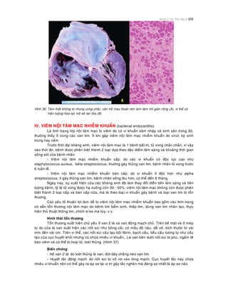 Bệnh lý Hệ Tim Mạch 131
Hình 36: Taâm thaát khoâng to nhöng cöùng chaéc, caûn trôû maùu thoaùt neân laøm taâm nhó giaõn roäng (A), vi theå coù
hieän töôïng hoùa sôïi moâ keõ lan toûa (B)
IV. VIEÂM NOÄI TAÂM MAÏC NHIEÃM KHUAÅN (bacterial endocarditis)
Laø tình traïng lôùp noäi taâm maïc bò vieâm do coù vi khuaån xaâm nhaäp vaø sinh saûn trong ñoù,
thöôøng thaáy ôû vuøng caùc van tim. Ít khi gaëp vieâm noäi taâm maïc nhieãm khuaån do viruùt, kyù sinh
truøng hay naám.
Tröôùc thôøi ñaïi khaùng sinh, vieâm noäi taâm maïc laø 1 beänh baát trò, töû vong chaéc chaén; vì vaäy
vaøo thôøi ñoù, beänh ñöôïc phaân bieät thaønh 2 loaïi döïa theo ñaëc ñieåm laâm saøng vaø khoaûng thôøi gian
soáng soùt cuûa beänh nhaân.
- Vieâm noäi taâm maïc nhieãm khuaån caáp: do caùc vi khuaån coù ñoäc löïc cao nhö
staphylococcus aureus, beâta streptococcus; thöôøng gaây thuûng van tim, beänh nhaân töû vong tröôùc
6 tuaàn leã.
- Vieâm noäi taâm maïc nhieãm khuaån baùn caáp: do vi khuaån ít ñoäc hôn nhö alpha
streptococcus, ít gaây thuûng van tim, beänh nhaân soáng laâu hôn, coù theå ñeán 6 thaùng.
Ngaøy nay, söï xuaát hieän cuûa caùc khaùng sinh ñaõ laøm thay ñoåi dieãn tieán laâm saøng vaø tieân
löôïng beänh, tyû leä töû vong ñöôïc haï xuoáng coøn 30 - 50%; vieâm noäi taâm maïc khoâng coøn ñöôïc phaân
bieät thaønh 2 loaïi caáp vaø baùn caáp nöõa, maø laø theo loaïi vi khuaån gaây beänh vaø loaïi van tim bò toån
thöông.
Caùc yeáu toá thuaän lôïi laøm deã bò vieâm noäi taâm maïc nhieãm khuaån bao goàm caùc tình traïng
coù saün toån thöông noäi taâm maïc do beänh tim baåm sinh, thaáp tim, duøng van tim nhaân taïo, thöïc
hieän thuû thuaät thoâng tim, chích xì ke ma tuùy, v.v.
Hình thaùi toån thöông:
Toån thöông xuaát hieän chuû yeáu ôû van 2 laù vaø van ñoäng maïch chuû. Treân beà maët vaø ôû meùp
töï do cuûa laù van xuaát hieän caùc noát suøi nhö boâng caûi, coù maàu ñoû naâu, deã vôõ, kích thöôùc töø vaøi
mm ñeán vaøi cm. Treân vi theå, caùc noát suøi caáu taïo bôûi fibrin, baïch caàu, tieåu caàu töông töï nhö caáu
taïo cuûa cuïc huyeát khoái nhöng coù chöùa nhieàu vi khuaån,. Laù van beân döôùi noát suøi bò phuø, ngaám teá
baøo vieâm vaø coù theå bò hoaïi töû, loeùt thuûng. (Hình 37)
Bieán chöùng:
- Hôû van 2 laù: do loeùt thuûng laù van, ñöùt daây chaèng neùo van tim
- Huyeát taéc ñoäng maïch: do noát suøi bò vôõ rôi vaøo loøng maïch. Cuïc huyeát taéc naøy chöùa
nhieàu vi khuaån neân coù theå gaây ra aùp xe taïi vò trí gaây taéc ngheõn maø ñaùng sôï nhaát laø aùp xe naõo.
 