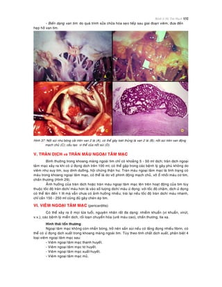 Bệnh lý Hệ Tim Mạch 132
- Bieán daïng van tim: do quaù trình söûa chöõa hoùa seïo tieáp sau giai ñoaïn vieâm, ñöa ñeán
heïp hôû van tim.
Hình 37: Noát suøi nhö boâng caûi treân van 2 laù (A), coù theå gaây loeùt thuûng laø van 2 laù (B); noát suøi treân van ñoäng
maïch chuû (C); caáu taïo vi theå cuûa noát suøi (D).
V. TRAØN DÒCH vaø TRAØN MAÙU NGOAÏI TAÂM MAÏC
Bình thöôøng trong khoang maøng ngoaøi tim chæ coù khoaûng 5 - 50 ml dòch; traøn dòch ngoaïi
taâm maïc xaûy ra khi coù öù ñoïng dòch treân 100 ml; coù theå gaëp trong caùc beänh lyù gaây phuø khoâng do
vieâm nhö suy tim, suy dinh döôõng, hoäi chöùng thaän hö. Traøn maùu ngoaïi taâm maïc laø tình traïng coù
maùu trong khoang ngoaïi taâm maïc, coù theå laø do vôõ phình ñoäng maïch chuû, vôõ oå nhoài maùu cô tim,
chaán thöông (Hình 29).
AÛnh höôûng cuûa traøn dòch hoaëc traøn maùu ngoaïi taâm maïc leân treân hoaït ñoäng cuûa tim tuøy
thuoäc toác ñoä traøn dòch/ maùu hôn laø vaøo soá löôïng dòch/ maùu öù ñoïng: vôùi toác ñoä chaäm, dòch öù ñoïng
coù theå leân ñeán 1 lít maø vaãn chöa coù aûnh höôûng nhieàu; traùi laïi neáu toác ñoä traøn dòch/ maùu nhanh,
chæ caàn 150 - 250 ml cuõng ñuû gaây cheøn eùp tim.
VI. VIEÂM NGOAÏI TAÂM MAÏC (pericarditis)
Coù theå xaûy ra ôû moïi löùa tuoåi, nguyeân nhaân raát ña daïng: nhieãm khuaån (vi khuaån, viruùt,
v.v.), caùc beänh lyù mieãn dòch, roái loaïn chuyeån hoùa (ureâ maùu cao), chaán thöông, tia xaï.
Hình thaùi toån thöông:
Ngoaïi taâm maïc khoâng coøn nhaün boùng, trôû neân saàn suøi neáu coù laéng ñoïng nhieàu fibrin, coù
theå coù öù ñoïng dòch xuaát trong khoang maøng ngoaøi tim. Tuøy theo tính chaát dòch xuaát, phaân bieät 4
loaïi vieâm ngoaïi taâm maïc sau:
- Vieâm ngoaïi taâm maïc thanh huyeát.
- Vieâm ngoaïi taâm maïc tô huyeát.
- Vieâm ngoaïi taâm maïc xuaát huyeát.
- Vieâm ngoaïi taâm maïc muû.
 