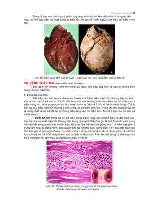 Bệnh lý Hệ Tim Mạch 133
Trong 3 loaïi sau, thöôøng coù phaûn öùng taêng sinh moâ sôïi laøm daày dính 2 laù ngoaïi taâm
maïc, coù theå gaây caûn trôû hoaït ñoäng co boùp cuûa tim (goïi laø vieâm ngoaïi taâm maïc co thaét) (Hình
38).
Hình 38: Vieâm ngoaïi taâm maïc tô huyeát – xuaát huyeát (A), vieâm ngoaïi taâm maïc co thaét (B)
VII. BEÄNH THAÁP TIM (rheumatic heart disease)
Bao goàm toån thöông vieâm tim trong giai ñoaïn soát thaáp caáp tính vaø caùc di chöùng bieán
daïng van tim maõn tính.
1. Vieâm tim (carditis)
Soát thaáp caáp tính (acute rheumatic fever) laø 1 beänh vieâm caáp tính, thöôøng hay taùi phaùt,
xaûy ra chuû yeáu ôû treû em 5-15 tuoåi. Soát thaáp caáp tính thöôøng xuaát hieän khoaûng 2-3 tuaàn sau 1
vieâm hoïng do beâta streptococcus tieâu huyeát nhoùm A (xaûy ra ôû 3% soá treû bò vieâm hoïng). Treû bò
soát, coù caùc bieåu hieän toån thöông ôû tim, khôùp, da vaø thaàn kinh; tuy nhieân chæ toån thöông cuûa tim
laø naëng nhaát vaø coù theå ñeå laïi di chöùng bieán daïng van tim maõn tính. Taát caû 3 lôùp cuûa tim ñeàu coù
theå bò vieâm:
- Vieâm cô tim: trong cô tim coù hieän töôïng thaám nhaäp caùc limphoâ baøo vaø ñaïi thöïc baøo,
ñaëc bieät coù söï xuaát hieän toån thöông ñaëc tröng cuûa beänh thaáp tim goïi laø theå Aschoff, naèm trong
moâ lieân keát xung quanh caùc maïch maùu. Caáu taïo cuûa theå Aschoff gioáng nhö 1 oå vieâm haït goàm 1
trung taâm hoaïi töû daïng fibrin, bao quanh bôûi caùc limphoâ baøo, töông baøo, vaø 1 loaïi ñaïi thöïc baøo
ñaëc bieät goïi teá baøo Anitschkow, coù nhaân chöùa 1 baêng chaát nhieãm saéc ôû chính giöõa, caùc teá baøo
Anitschkow coù theå hoøa nhaäp thaønh caùc ñaïi baøo nhieàu nhaân. Theå Aschoff cuõng coù theå ñöôïc tìm
thaáy trong lôùp noäi taâm maïc vaø ngoaïi taâm maïc. (Hình 39)
Hình 39: Theå Aschoff trong cô tim, trong oâ nhoû laø 2 teá baøo Anitschkow
vôùi nhaân chöùa baêng chaát nhieãm saéc ôû giöõa.
 