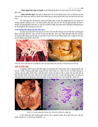 Bệnh lý Hệ Tim Mạch 134
- Vieâm ngoaïi taâm maïc tô huyeát: coù söï laéng ñoïng fibrin ôû maët trong cuûa caû 2 laù ngoaïi
taâm maïc.
- Vieâm noäi taâm maïc: chuû yeáu ôû vuøng van 2 laù vaø van ñoäng maïch chuû, coù theå taïo ra caùc
noát suøi treân meùp van. Noát suøi ñöôïc hình thaønh do söï keát tuï fibrin treân caùc veát loeùt cuûa noäi taâm
maïc.
Cô cheá gaây toån thöông tim trong soát thaáp caáp coù theå do streptococcus coù chöùa caùc
khaùng nguyeân töông töï vôùi 1 soá thaønh phaàn caáu taïo cuûa van tim (thí duï giöõa protein M cuûa vi
khuaån vôùi glycoprotein cuûa tim); vì vaäy khi cô theå coù ñaùp öùng mieãn dòch choáng laïi streptococcus
thì cuõng gaây ra toån thöông cho van tim.
2. Di chöùng bieán daïng van tim maõn tính:
Laø haäu quaû quaù trình hoùa seïo vaø co keùo cuûa caùc toån thöông van tim ñaõ xaûy ra trong giai
ñoaïn soát thaáp caáp tính. Caùc van tim bò hoùa sôïi daày leân, dính vaøo nhau daãn ñeán heïp hôû van tim.
Di chöùng bieán daïng van tim xaûy ra chuû yeáu ôû van 2 laù vaø van ñoäng maïch chuû, ít gaëp ôû van 3 laù
vaø van ñoäng maïch phoåi. (Hình 40)
Hình 40: Caùc laù van cuûa van 2 laù daày leân, dính caùc daây chaèng neùo van (A), di chöùng heïp van 2 laù (B).
VIII. U CUÛA TIM
U nguyeân phaùt cuûa tim raát hieám gaëp, thöôøng laønh tính. Gaàn phaân nöûa u nguyeân phaùt cuûa
tim laø u nhaày, thöôøng xuaát hieän trong nhó traùi, kích thöôùc töø 1 ñeán 10 cm, coù hoaëc khoâng coù
cuoáng, caáu taïo goàm nhieàu thuøy, maät ñoä meàm, boùng. Veà maët vi theå, u ñöôïc caáu taïo bôûi caùc teá
baøo ña giaùc hoaëc hình sao, xeáp raûi raùc hoaëc thaønh ñaùm treân 1 chaát neàn daïng nieâm. U nhaày coù
theå gaây caûn trôû hoaït ñoäng cuûa van 2 laù hoaëc vôõ bong ra thaønh caùc cuïc huyeát taéc. (Hình 41)
Hình 41: U nhaày trong taâm nhó traùi (A), hình aûnh vi theå cuûa u nhaày (B).
U thöù phaùt cuûa tim thöôøng gaëp hôn so vôùi u nguyeân phaùt, do di caên cuûa caùc ung thö
phoåi, ung thö vuù, u haéc toá aùc, limphoâm, v.v.
 