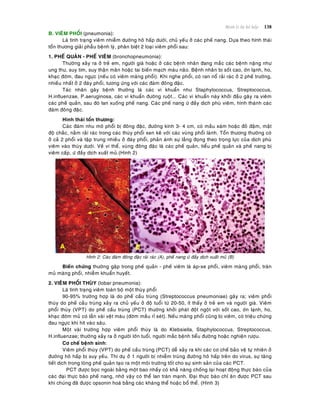 Beänh lyù heä hoâ haáp 138
B. VIEÂM PHOÅI (pneumonia):
Laø tình traïng vieâm nhieãm ñöôøng hoâ haáp döôùi, chuû yeáu ôû caùc pheá nang. Döïa theo hình thaùi
toån thöông giaûi phaãu beänh lyù, phaân bieät 2 loaïi vieâm phoåi sau:
1. PHEÁ QUAÛN - PHEÁ VIEÂM (bronchopneumonia):
Thöôøng xaûy ra ôû treû em, ngöôøi giaø hoaëc ôû caùc beänh nhaân ñang maéc caùc beänh naëng nhö
ung thö, suy tim, suy thaän maõn hoaëc tai bieán maïch maùu naõo. Beänh nhaân bò soát cao, ôùn laïnh, ho,
khaïc ñôøm, ñau ngöïc (neáu coù vieâm maøng phoåi). Khi nghe phoåi, coù ran noå raûi raùc ôû 2 pheá tröôøng,
nhieàu nhaát ôû 2 ñaùy phoåi, töông öùng vôùi caùc ñaùm ñoâng ñaëc.
Taùc nhaân gaây beänh thöôøng laø caùc vi khuaån nhö Staphylococcus, Streptococcus,
H.influenzae, P.aeruginosa, caùc vi khuaån ñöôøng ruoät... Caùc vi khuaån naøy khôûi ñaàu gaây ra vieâm
caùc pheá quaûn, sau ñoù lan xuoáng pheá nang. Caùc pheá nang öù ñaày dòch phuø vieâm, hình thaønh caùc
ñaùm ñoâng ñaëc.
Hình thaùi toån thöông:
Caùc ñaùm nhu moâ phoåi bò ñoâng ñaëc, ñöôøng kính 3- 4 cm, coù maàu xaùm hoaëc ñoû ñaäm, maät
ñoä chaéc, naèm raûi raùc trong caùc thuøy phoåi xen keõ vôùi caùc vuøng phoåi laønh. Toån thöông thöôøng coù
ôû caû 2 phoåi vaø taäp trung nhieàu ôû ñaùy phoåi, phaûn aùnh söï laéng ñoïng theo troïng löïc cuûa dòch phuø
vieâm vaøo thuøy döôùi. Veà vi theå, vuøng ñoâng ñaëc laø caùc pheá quaûn, tieåu pheá quaûn vaø pheá nang bò
vieâm caáp, öù ñaày dòch xuaát muû.(Hình 2)
Hình 2: Caùc ñaùm ñoâng ñaëc raûi raùc (A), pheá nang öù ñaày dòch xuaát muû (B)
Bieán chöùng thöôøng gaëp trong pheá quaûn - pheá vieâm laø aùp-xe phoåi, vieâm maøng phoåi, traøn
muû maøng phoåi, nhieãm khuaån huyeát.
2. VIEÂM PHOÅI THUØY (lobar pneumonia):
Laø tình traïng vieâm toaøn boä moät thuøy phoåi
90-95% tröôøng hôïp laø do pheá caàu truøng (Streptococcus pneumoniae) gaây ra; vieâm phoåi
thuøy do pheá caàu truøng xaûy ra chuû yeáu ôû ñoä tuoåi töø 20-50, ít thaáy ôû treû em vaø ngöôøi giaø. Vieâm
phoåi thuøy (VPT) do pheá caàu truøng (PCT) thöôøng khôûi phaùt ñoät ngoät vôùi soát cao, ôùn laïnh, ho,
khaïc ñôøm muû coù laãn vaøi veät maùu (ñôøm maàu ræ seùt). Neáu maøng phoåi cuõng bò vieâm, coù trieäu chöùng
ñau ngöïc khi hít vaøo saâu.
Moät vaøi tröôøng hôïp vieâm phoåi thuøy laø do Klebsiella, Staphylococcus, Streptococcus,
H.influenzae; thöôøng xaûy ra ôû ngöôøi lôùn tuoåi, ngöôøi maéc beänh tieåu ñöôøng hoaëc nghieän röôïu.
Cô cheá beänh sinh:
Vieâm phoåi thuøy (VPT) do pheá caàu truøng (PCT) deã xaûy ra khi caùc cô cheá baûo veä töï nhieân ôû
ñöôøng hoâ haáp bò suy yeáu. Thí duï ôû 1 ngöôøi bò nhieãm truøng ñöôøng hoâ haáp treân do virus, söï taêng
tieát dòch trong loøng pheá quaûn taïo ra moät moâi tröôøng toát cho söï sinh saûn cuûa caùc PCT.
PCT ñöôïc boïc ngoaøi baèng moät bao nhaày coù khaû naêng choáng laïi hoaït ñoäng thöïc baøo cuûa
caùc ñaïi thöïc baøo pheá nang, nhôø vaäy coù theå lan traøn maïnh. Ñaïi thöïc baøo chæ aên ñöôïc PCT sau
khi chuùng ñaõ ñöôïc opsonin hoaù baèng caùc khaùng theå hoaëc boå theå. (Hình 3)
 