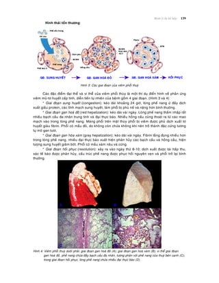 Beänh lyù heä hoâ haáp 139
Hình thaùi toån thöông:
Hình 3: Caùc giai ñoaïn cuûa vieâm phoåi thuyø
Caùc ñaëc ñieåm ñaïi theå vaø vi theåù cuûa vieâm phoåi thuøy laø moät thí duï ñieån hình veà phaûn öùng
vieâm muû-tô huyeát caáp tính, dieãn tieán töï nhieân cuûa beänh goàm 4 giai ñoaïn. (Hình 3 vaø 4)
* Giai ñoaïn sung huyeát (congestion): keùo daøi khoaûng 24 giôø, loøng pheá nang öù ñaày dòch
xuaát giaàu protein, caùc tónh maïch sung huyeát, laøm phoåi bò phuø neà vaø naëng hôn bình thöôøng.
* Giai ñoaïn gan hoaù ñoû (red hepatization): keùo daøi vaøi ngaøy. Loøng pheá nang thaám nhaäp raát
nhieàu baïch caàu ña nhaân trung tính vaø ñaïi thöïc baøo. Nhieàu hoàng caàu cuõng thoaùt ra töø caùc mao
maïch vaøo trong loøng pheá nang. Maøng phoåi treân maët thuøy phoåi bò vieâm ñöôïc phuû dòch xuaát tô
huyeát giaøu fibrin. Phoåi coù maàu ñoû, do khoâng coøn chöùa khoâng khí neân trôû thaønh ñaëc cöùng töông
töï moâ gan töôi.
* Giai ñoaïn gan hoùa xaùm (gray hepatization): keùo daøi vaøi ngaøy. Fibrin laéng ñoïng nhieàu hôn
trong loøng pheá nang, nhieàu ñaïi thöïc baøo xuaát hieän phaân huûy caùc baïch caàu vaø hoàng caàu, hieän
töôïng sung huyeát giaûm bôùt. Phoåi coù maàu xaùm naâu vaø cöùng.
* Giai ñoaïn hoài phuïc (resolution): xaûy ra vaøo ngaøy thöù 8-10; dòch xuaát ñöôïc taùi haáp thu,
xaùc teá baøo ñöôïc phaân huûy, caáu truùc pheá nang ñöôïc phuïc hoài nguyeân veïn vaø phoåi trôû laïi bình
thöôøng.
Hình 4: Vieâm phoåi thuyø döôùi phaûi: giai ñoaïn gan hoaù ñoû (A); giai ñoaïn gan hoaù xaùm (B); vi theå giai ñoaïn
gan hoaù ñoû, pheá nang chöùa ñaày baïch caàu ña nhaân, töông phaûn vôùi pheá nang cuûa thuyø beân caïnh (C);
trong giai ñoaïn hoài phuïc, loøng pheá nang chöùa nhieàu ñaïi thöïc baøo (D).
 
