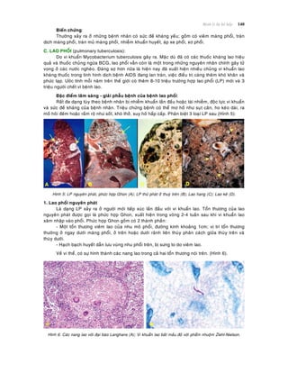 Beänh lyù heä hoâ haáp 140
Bieán chöùng:
Thöôøng xaûy ra ôû nhöõng beänh nhaân coù söùc ñeà khaùng yeáu; goàm coù vieâm maøng phoåi, traøn
dòch maøng phoåi, traøn muû maøng phoåi, nhieãm khuaån huyeát, aùp xe phoåi, xô phoåi.
C. LAO PHOÅI (pulmonary tuberculosis):
Do vi khuaån Mycobacterium tuberculosis gaây ra. Maëc duø ñaõ coù caùc thuoác khaùng lao hieäu
quaû vaø thuoác chuûng ngöøa BCG, lao phoåi vaãn coøn laø moät trong nhöõng nguyeân nhaân chính gaây töû
vong ôû caùc nöôùc ngheøo. Ñaùng sôï hôn nöõa laø hieän nay ñaõ xuaát hieän nhieàu chuûng vi khuaån lao
khaùng thuoác trong tình hình dòch beänh AIDS ñang lan traøn, vieäc ñieàu trò caøng theâm khoù khaên vaø
phöùc taïp. Öôùc tính moãi naêm treân theá giôùi coù theâm 8-10 trieäu tröôøng hôïp lao phoåi (LP) môùi vaø 3
trieäu ngöôøi cheát vì beänh lao.
Ñaëc ñieåm laâm saøng - giaûi phaãu beänh cuûa beänh lao phoåi:
Raát ña daïng tuøy theo beänh nhaân bò nhieãm khuaån laàn ñaàu hoaëc taùi nhieãm, ñoäc löïc vi khuaån
vaø söùc ñeà khaùng cuûa beänh nhaân. Trieäu chöùng beänh coù theå mô hoà nhö suït caân, ho keùo daøi, ra
moà hoâi ñeâm hoaëc raàm roä nhö soát, khoù thôû, suy hoâ haáp caáp. Phaân bieät 3 loaïi LP sau (Hình 5):
Hình 5: LP nguyeân phaùt, phöùc hôïp Ghon (A); LP thöù phaùt ôû thuyø treân (B); Lao hang (C); Lao keâ (D).
1. Lao phoåi nguyeân phaùt
Laø daïng LP xaûy ra ôû ngöôøi môùi tieáp xuùc laàn ñaàu vôùi vi khuaån lao. Toån thöông cuûa lao
nguyeân phaùt ñöôïc goïi laø phöùc hôïp Ghon, xuaát hieän trong voøng 2-4 tuaàn sau khi vi khuaån lao
xaâm nhaäp vaøo phoåi. Phöùc hôïp Ghon goàm coù 2 thaønh phaàn:
- Moät toån thöông vieâm lao cuûa nhu moâ phoåi, ñöôøng kính khoaûng 1cm; vò trí toån thöông
thöôøng ôû ngay döôùi maøng phoåi, ôû treân hoaëc döôùi raõnh lieân thuøy phaân caùch giöõa thuøy treân vaø
thuøy döôùi.
- Haïch baïch huyeát daãn löu vuøng nhu phoåi treân, bò söng to do vieâm lao.
Veà vi theå, coù söï hình thaønh caùc nang lao trong caû hai toån thöông noùi treân. (Hình 6).
Hình 6: Caùc nang lao vôùi ñaïi baøo Langhans (A); Vi khuaån lao baét maàu ñoû vôùi phaåm nhuoäm Ziehl-Nielson.
 