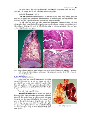 Beänh lyù heä hoâ haáp 142
Pheá quaûn giaõn ra laøm muû öù laïi caøng nhieàu, nhieåm khuaån caøng naëng, thaønh pheá quaûn
caøng yeáu. Toån thöông tieáp tuïc tieán trieån theo moät voøng laån quaån.
Hình thaùi toån thöông (Hình 7):
- Ñaïi theå: giaõn pheá quaûn thöôøng coù ôû caû hai phoåi vaø taäp trung nhieàu ôû thuøy döôùi. Pheá
quaûn giaõn coù ñöôøng kính lôùn gaáp 5-6 laàn bình thöôøng; coù hình oáng, hình thoi hoaëc hình tuùi; trong
loøng chöùa ñaày dòch xuaát muû vaø coù hieän töôïng xô hoaù quanh pheá quaûn.
- Vi theå: thaønh pheá quaûn giaõn thaám nhaäp nhieàu teá baøo vieâm maõn tính vaø ñöôïc thay baèng
moâ haït vieâm. Bieåu moâ phuû coù choã bong troùc hoaëc chuyeån saûn gai (töø bieåu moâ hoâ haáp chuyeån
thaønh bieåu moâ laùt taàng). Khi beänh ñaõ dieãn tieán laâu ngaøy, coù hieän töôïng hoaù sôïi thaønh pheá quaûn
vaø nhu moâ phoåi quanh pheá quaûn.
Hinh 7: Giaõn pheá quaûn vaø xô hoaù quanh pheá quaûn (muõi teân, A); Loøng pheá quaûn chöùa ñaày muû (1), bong troùc
bieåu moâ phuû (2), thaønh pheá quaûn xô hoaù, thaám nhaäp teá baøo vieâm maõn tính (3, B); Bieåu moâ phuû bò
chuyeån saûn gai (1, C).
III. XEÏP PHOÅI (atelectasis):
Laø tình traïng nhu moâ phoåi bò xeïp khoâng coøn chöùa
khoâng khí (Hình 8); ñaây laø moät toån thöông khaû hoài vì
nhu moâ phoåi xeïp coù theå phình trôû laïi khi nguyeân nhaân
ñöôïc giaûi quyeát; tuy nhieân xeïp phoåi naëng coù theå laøm
giaûm söï oxy hoaù maùu vaø taïo thuaän lôïi cho nhieãm khuaån
hoâ haáp.
Phaân bieät 2 loaïi xeïp phoåi chính:
- Xeïp phoåi taéc ngheõn: xaûy ra khi moät pheá quaûn bò
taéc ngheõn hoaøn toaøn, khoâng khí trong nhu moâ phoåi beân
döôùi choã taéc ngheõn ñöôïc taùi haáp thu laøm phoåi xeïp
xuoáng vaø keùo leäch trung thaát veà phía toån thöông. Pheá
quaûn bò taéc ngheõn thöôøng do taêng tieát vaø öù keït ñôøm
nhôùt, vì vaäy hay gaëp trong beänh hen pheá quaûn, giaõn
pheá quaûn, vieâm pheá quaûn maõn tính vaø caùc tình traïng
haäu phaãu; pheá quaûn cuõng coù khi bò taéc do moät vaät laï töø
ngoaøi loït vaøo.
Hình 8: Xeïp phoåi traùi.
 
