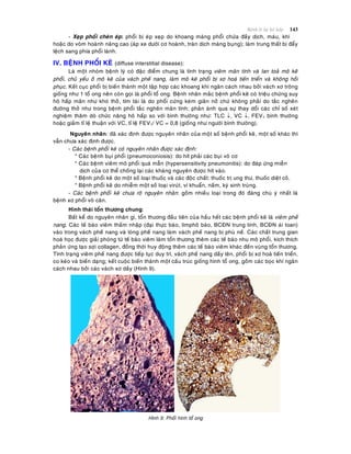 Beänh lyù heä hoâ haáp 143
- Xeïp phoåi cheøn eùp: phoåi bò eùp xeïp do khoang maøng phoåi chöùa ñaày dòch, maùu, khí
hoaëc do voøm hoaønh naâng cao (aùp xe döôùi cô hoaønh, traøn dòch maøng buïng); laøm trung thaát bò ñaåy
leäch sang phía phoåi laønh.
IV. BEÄNH PHOÅI KEÕ (diffuse interstitial disease):
Laø moät nhoùm beänh lyù coù ñaëc ñieåm chung laø tình traïng vieâm maõn tính vaø lan toaû moâ keõõ
phoåi, chuû yeáu ôû moâ keõ cuûa vaùch pheá nang, laøm moâ keõ phoåi bò xô hoaù tieán trieån vaø khoâng hoài
phuïc. Keát cuïc phoåi bò bieán thaønh moät taäp hôïp caùc khoang khí ngaên caùch nhau bôûi vaùch xô troâng
gioáng nhö 1 toå ong neân coøn goïi laø phoåi toå ong. Beänh nhaân maéc beänh phoåi keõ coù trieäu chöùng suy
hoâ haáp maõn nhö khoù thôû, tím taùi laø do phoåi cöùng keùm giaõn nôû chöù khoâng phaûi do taéc ngheõn
ñöôøng thôû nhö trong beänh phoåi taéc ngheõn maõn tính; phaûn aùnh qua söï thay doåi caùc chæ soá xeùt
nghieäm thaêm doø chöùc naêng hoâ haáp so vôùi bình thöôøng nhö: TLC , VC , FEV1 bình thöôøng
hoaëc giaûm tæ leä thuaän vôùi VC, tæ leä FEV1/ VC = 0,8 (gioáng nhö ngöôøi bình thöôøng).
Nguyeân nhaân: ñaõ xaùc ñònh ñöôïc nguyeân nhaân cuûa moät soá beänh phoåi keõ, moät soá khaùc thì
vaãn chöa xaùc ñònh ñöôïc.
- Caùc beänh phoåi keõ coù nguyeân nhaân ñöôïc xaùc ñònh:
* Caùc beänh buïi phoåi (pneumoconiosis): do hít phaûi caùc buïi voâ cô
* Caùc beänh vieâm moâ phoåi quaù maãn (hypersensitivity pneumonitis): do ñaùp öùng mieãn
dòch cuûa cô theå choáng laïi caùc khaùng nguyeân ñöôïc hít vaøo.
* Beänh phoåi keõ do moät soá loaïi thuoác vaø caùc ñoäc chaát: thuoác trò ung thö, thuoác dieät coû.
* Beänh phoåi keõ do nhieãm moät soá loaïi viruùt, vi khuaån, naám, kyù sinh truøng.
- Caùc beänh phoåi keõ chöa roõ nguyeân nhaân: goàm nhieàu loaïi trong ñoù ñaùng chuù yù nhaát laø
beänh xô phoåi voâ caên.
Hình thaùi toån thöông chung:
Baát keå do nguyeân nhaân gì, toån thöông ñaàu tieân cuûa haàu heát caùc beänh phoåi keõ laø vieâm pheá
nang. Caùc teá baøo vieâm thaám nhaäp (ñaïi thöïc baøo, limphoâ baøo, BCÑN trung tính, BCÑN aùi toan)
vaøo trong vaùch pheá nang vaø loøng pheá nang laøm vaùch pheá nang bò phuø neà. Caùc chaát trung gian
hoaù hoïc ñöôïc giaûi phoùng töø teá baøo vieâm laøm toån thöông theâm caùc teá baøo nhu moâ phoåi, kích thích
phaûn öùng taïo sôïi collagen, ñoàng thôøi huy ñoäng theâm caùc teá baøo vieâm khaùc ñeán vuøng toån thöông.
Tình traïng vieâm pheá nang ñöôïc tieáp tuïc duy trì, vaùch pheá nang daày leân, phoåi bò xô hoaù tieán trieån,
co keùo vaø bieán daïng; keát cuoäc bieán thaønh moät caáu truùc gioáng hình toå ong, goàm caùc boïc khí ngaên
caùch nhau bôûi caùc vaùch xô daày (Hình 9).
Hình 9: Phoåi hình toå ong
 