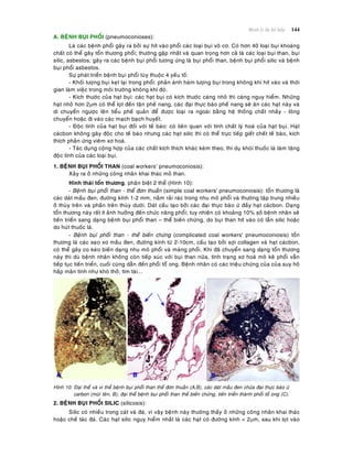 Beänh lyù heä hoâ haáp 144
A. BEÄNH BUÏI PHOÅI (pneumoconioses):
Laø caùc beänh phoåi gaây ra bôûi söï hít vaøo phoåi caùc loaïi buïi voâ cô. Coù hôn 40 loaïi buïi khoaùng
chaát coù theå gaây toån thöông phoåi; thöôøng gaëp nhaát vaø quan troïng hôn caû laø caùc loaïi buïi than, buïi
silic, asbestos; gaây ra caùc beänh buïi phoåi töông öùng laø buïi phoåi than, beänh buïi phoåi silic vaø beänh
buïi phoåi asbestos.
Söï phaùt trieån beänh buïi phoåi tuøy thuoäc 4 yeáu toá:
- Khoái löôïng buïi keït laïi trong phoåi: phaûn aùnh haøm löôïng buïi trong khoâng khí hít vaøo vaø thôøi
gian laøm vieäc trong moâi tröôøng khoâng khí ñoù.
- Kích thöôùc cuûa haït buïi: caùc haït buïi coù kích thöôùc caøng nhoû thì caøng nguy hieåm. Nhöõng
haït nhoû hôn 2m coù theå loït ñeán taän pheá nang, caùc ñaïi thöïc baøo pheá nang seõ aên caùc haït naøy vaø
di chuyeån ngöôïc leân tieåu pheá quaûn ñeå ñöôïc loaïi ra ngoaøi baèng heä thoáng chaát nhaày - loâng
chuyeån hoaëc ñi vaøo caùc maïch baïch huyeát.
- Ñoäc tính cuûa haït buïi ñoái vôùi teá baøo: coù lieân quan vôùi tính chaát lyù hoaù cuûa haït buïi. Haït
caùcbon khoâng gaây ñoäc cho teá baøo nhöng caùc haït silic thì coù theå tröïc tieáp gieát cheát teá baøo, kích
thích phaûn öùng vieâm xô hoaù.
- Taùc duïng coäng hôïp cuûa caùc chaát kích thích khaùc keøm theo, thí duï khoùi thuoác laù laøm taêng
ñoäc tính cuûa caùc loaïi buïi.
1. BEÄNH BUÏI PHOÅI THAN (coal workers’ pneumoconiosis):
Xaûy ra ôû nhöõng coâng nhaân khai thaùc moû than.
Hình thaùi toån thöông, phaân bieät 2 theå (Hình 10):
- Beänh buïi phoåi than - theå ñôn thuaàn (simple coal workers' pneumoconiosis): toån thöông laø
caùc daùt maàu ñen, ñöôøng kính 1-2 mm, naèm raûi raùc trong nhu moâ phoåi vaø thöôøng taäp trung nhieàu
ôû thuøy treân vaø phaàn treân thuøy döôùi. Daùt caáu taïo bôûi caùc ñaïi thöïc baøo öù ñaày haït caùcbon. Daïng
toån thöông naøy raát ít aûnh höôûng ñeán chöùc naêng phoåi; tuy nhieân coù khoaûng 10% soá beänh nhaân seõ
tieán trieån sang daïng beänh buïi phoåi than – theå bieán chöùng, do buïi than hít vaøo coù laãn silic hoaëc
do huùt thuoác laù.
- Beänh buïi phoåi than - theå bieán chöùng (complicated coal workers' pneumoconiosis) toån
thöông laø caùc seïo xô maàu ñen, ñöôøng kính töø 2-10cm, caáu taïo bôûi sôïi collagen vaø haït caùcbon,
coù theå gaây co keùo bieán daïng nhu moâ phoåi vaø maøng phoåi. Khi ñaõ chuyeån sang daïng toån thöông
naøy thì duø beänh nhaân khoâng coøn tieáp xuùc vôùi buïi than nöõa, tình traïng xô hoaù moâ keõ phoåi vaãn
tieáp tuïc tieán trieån, cuoái cuøng daãn ñeán phoåi toå ong. Beänh nhaân coù caùc trieäu chöùng cuûa cuûa suy hoâ
haáp maõn tính nhö khoù thôû, tím taùi...
Hình 10: Ñaïi theå vaø vi theå beänh buïi phoåi than theå ñôn thuaàn (A,B), caùc daùt maàu ñen chöùa ñaïi thöïc baøo öù
carbon (muõi teân, B); ñaïi theå beänh buïi phoåi than theå bieán chöùng, tieán trieån thaønh phoåi toå ong (C).
2. BEÄNH BUÏI PHOÅI SILIC (silicosis):
Silic coù nhieàu trong caùt vaø ñaù, vì vaäy beänh naøy thöôøng thaáy ôû nhöõng coâng nhaân khai thaùc
hoaëc cheá taùc ñaù. Caùc haït silic nguy hieåm nhaát laø caùc haït coù ñöôøng kính < 2m, sau khi loït vaøo
 