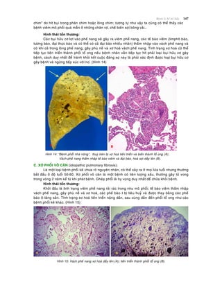 Beänh lyù heä hoâ haáp 147
chim” do hít buïi trong phaân chim hoaëc loâng chim; töông töï nhö vaäy ta cuõng coù theå thaáy caùc
beänh vieâm moâ phoåi quaù maãn ôû nhöõng chaên vòt, cheá bieán sôïi boâng vaûi…
Hình thaùi toån thöông:
Caùc buïi höõu cô loït vaøo pheá nang seõ gaây ra vieâm pheá nang, caùc teá baøo vieâm (limphoâ baøo,
töông baøo, ñaïi thöïc baøo vaø coù theå coù caû ñaïi baøo nhieàu nhaân) thaám nhaäp vaøo vaùch pheá nang vaø
coù khi caû trong loøng pheá nang, gaây phuø neà vaø xô hoaù vaùch pheá nang. Tình traïng xô hoaù coù theå
tieáp tuïc tieán trieån thaønh phoåi toå ong neáu beänh nhaân vaãn tieáp tuïc hít phaûi loaïi buïi höõu cô gaây
beänh, caùch duy nhaát ñeå traùnh khoûi keát cuoäc ñaùng sôï naøy laø phaûi xaùc ñònh ñöôïc loaïi buïi höõu cô
gaây beänh vaø ngöøng tieáp xuùc vôùi no.ù (Hình 14)
Hình 14: “Beänh phoåi nhaø noâng”, thuyø treân bò xô hoaù tieán trieån vaø bieán thaønh toå ong (A);
Vaùch pheá nang thaám nhaäp teá baøo vieâm vaø ñaïi baøo, hoaù sôïi daày leân (B).
C. XÔ PHOÅI VOÂ CAÊN (idiopathic pulmonary fibrosis):
Laø moät loaïi beänh phoåi keõ chöa roõ nguyeân nhaân, coù theå xaûy ra ôû moïi löùa tuoåi nhöng thöôøng
baét ñaàu ôû ñoä tuoåi 50-60. Xô phoåi voâ caên laø moät beänh coù tieân löôïng xaáu, thöôøng gaây töû vong
trong voøng 2 naêm keå töø khi phaùt beänh. Gheùp phoåi laø hy voïng duy nhaát ñeå chöõa khoûi beänh.
Hình thaùi toån thöông:
Khôûi ñaàu laø tình traïng vieâm pheá nang raûi raùc trong nhu moâ phoåi; teá baøo vieâm thaám nhaäp
vaùch pheá nang, gaây phuø neà vaø xô hoaù, caùc pheá baøo I bò tieâu huyû vaø ñöôïc thay baèng caùc pheá
baøo II taêng saûn. Tình traïng xô hoaù tieán trieån naëng daàn, sau cuøng daãn ñeán phoåi toå ong nhö caùc
beänh phoåi keõ khaùc. (Hình 15)
Hình 15: Vaùch pheá nang xô hoaù daày leân (A); tieán trieån thaønh phoåi toå ong (B).
 