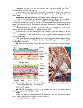 Beänh lyù heä hoâ haáp 149
- Hen do dò öùng: xaûy ra do ñaùp öùng quaù mieãn tyùp 1 cuûa cô theå ñoái vôùi caùc dò öùng
nguyeân coù trong buïi, phaán hoa, loâng thuù...
- Hen khoâng do dò öùng: thöôøng xaûy ra sau caùc vieâm ñöôøng hoâ haáp do viruùt (rhinovirus,
parainfluenza virus), hoaëc do thôøi tieát laïnh giaù, khoâng khí oâ nhieãm, hoaït ñoäng gaéng söùc, caùc
stress taâm lyù...
Cô cheá beänh sinh: töông ñoái ñöôïc hieåu roõ trong loaïi hen pheá quaûn do dò öùng.
Khi beänh nhaân hít phaûi caùc dò öùng nguyeân maø cô theå ñaõ ñöôïc maãn caûm töø tröôùc, ñaùp öùng
quaù maãn tyùp 1 seõ xaûy ra. Caùc dò öùng nguyeân naøy gaén leân caùc IgE treân beà maët caùc masto baøo,
coù saün trong nieâm maïc pheá quaûn. Söï gaén keát naøy laøm masto baøo ñöôïc hoaït hoaù vaø giaûi phoùng
ra caùc chaát trung gian hoaù hoïc nhö histamine, leukotrien, prostaglandin, cytokin vaø protease coù
taùc duïng:
- Kích thích cô trôn gaây co thaét pheá quaûn moät caùch tröïc tieáp hoaëc giaùn tieáp qua trung gian
phaûn xaï thaàn kinh phoù giao caûm (Tk X); laøm heïp loøng pheá quaûn.
- Kích thích nieâm maïc pheá quaûn taêng tieát nhaày, coù theå taïo thaønh nuùt nhaày laøm bít taéc pheá
quaûn.
- Laøm giaõn maïch vaø taêng tính thaám thaønh maïch, gaây phuø neà nieâm maïc pheá quaûn laøm heïp
theâm loøng pheá quaûn.
- Thu huùt vaø hoaït hoaù caùc baïch caàu ña nhaân (trung tính, aùi toan), tieåu caàu. Caùc teá baøo naøy
giaûi phoùng caùc chaát trung gian hoaù hoïc coù taùc duïng töông töï treân, ngoaøi ra coøn coù theå gaây toån
thöông nieâm maïc pheá quaûn.
Keát quaû laø loøng pheá quaûn bò thu heïp, khaùng löïc ñöôøng thôû taêng gaây taéc ngheõn thoâng khí.
(Hình 17A)
Hình 17: So saùnh giöõa pheá quaûn bình thöôøng vaø hen pheá quaûn (A ; Moät tröôøng hôïp hen aùc tính töû vong do
nuùt nhaày bít hoaøn toaøn chaïc 3 khí pheá quaûn (B).
Hình thaùi toån thöông:
Ñaïi theå: phoåi caêng phoàng, coù theå coù moät vaøi vuøng xeïp phoåi nhoû do loøng caùc pheá quaûn bò
bít taéc hoaøn toaøn bôûi nuùt nhaày. (Hình 17B)
Vi theå:
- Nieâm maïc pheá quaûn sung huyeát, phuø neà vaø thaám nhaäp caùc teá baøo vieâm (chuû yeáu laø caùc
BCÑN aùi toan); bieåu moâ coù nhöõng vuøng bò hoaïi töû, bong troùc.
- Maøng ñaùy döôùi bieåu moâ daày leân.
 