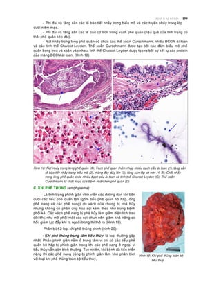 Beänh lyù heä hoâ haáp 150
- Phì ñaïi vaø taêng saûn caùc teá baøo tieát nhaày trong bieåu moâ vaø caùc tuyeán nhaày trong lôùp
döôùi nieâm maïc.
- Phì ñaïi vaø taêng saûn caùc teá baøo cô trôn trong vaùch pheá quaûn (haäu quaû cuûa tình traïng co
thaét pheá quaûn keùo daøi).
- Nuùt nhaày trong loøng pheá quaûn coù chöùa caùc theå xoaén Curschmann, nhieàu BCÑN aùi toan
vaø caùc tinh theå Charcot-Leyden. Theå xoaén Curschmann ñöôïc taïo bôûi caùc ñaùm bieåu moâ pheá
quaûn bong troùc vaø xoaén vaøo nhau, tinh theå Charcot-Leyden ñöôïc taïo ra bôûi söï keát tuï caùc protein
cuûa maøng BCÑN aùi toan. (Hình 18)
Hình 18: Nuùt nhaày trong loøng pheá quaûn (A); Vaùch pheá quaûn thaám nhaäp nhieàu baïch caàu aùi toan (1), taêng saûn
teá baøo tieát nhaày trong bieåu moâ (2), maøng ñaùy daày leân (3), taêng saûn lôùp cô trôn (4, B); Chaát nhaày
trong loøng pheá quaûn chöùa nhieàu baïch caàu aùi toan vaø tinh theå Charcot-Leyden (C); Theå xoaén
Curschmann töø chaát khaïc cuûa beänh nhaân hen pheá quaûn (D)
C. KHÍ PHEÁ THUÕNG (emphysema):
Laø tình traïng phình giaõn vónh vieãn caùc ñöôøng daãn khí beân
döôùi caùc tieåu pheá quaûn taän (goàm tieåu pheá quaûn hoâ haáp, oáng
pheá nang vaø caùc pheá nang) do vaùch cuûa chuùng bò phaù huûy
nhöng khoâng coù phaûn öùng hoaù sôïi keøm theo nhö trong beänh
phoåi keõ. Caùc vaùch pheá nang bò phaù huûy laøm giaûm dieän tích trao
ñoåi khí; nhu moâ phoåi maát caùc sôïi chun neân giaûm khaû naêng co
hoài, giaûm löïc ñaåy khí ra ngoaøi trong thì thôû ra (Hình 19).
Phaân bieät 2 loaïi khí pheá thuõng chính (hình 20):
- Khí pheá thuõng trung taâm tieåu thuøy: laø loaïi thöôøng gaëp
nhaát. Phaàn phình giaõn naèm ôû trung taâm vì chæ coù caùc tieåu pheá
quaûn hoâ haáp bò phình giaõn trong khi caùc pheá nang ôû ngoaïi vi
tieåu thuøy vaãn coøn bình thöôøng. Tuy nhieân, khi beänh ñaõ tieán trieån
naëng thì caùc pheá nang cuõng bò phình giaõn laøm khoù phaân bieät
vôùi loaïi khí pheá thuõng toaøn boä tieåu thuøy.
Hình 19: Khí pheá thuõng toaøn boä
tieåu thuyø
 