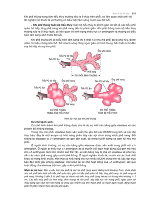 Beänh lyù heä hoâ haáp 151
Khí pheá thuõng trung taâm tieåu thuøy thöôøng xaûy ra ôû thuøy treân phoåi, coù lieân quan chaët cheõ vôùi
taät nghieän huùt thuoác laù vaø thöôøng coù bieåu hieän laâm saøng muoän sau 50 tuoåi.
- Khí pheá thuõng toaøn boä tieåu thuøy: toaøn boä tieåu thuøy bò phình giaõn do taát caû caùc tieåu pheá
quaûn hoâ haáp, oáng pheá nang vaø pheá nang ñeàu bò phình giaõn. Khí pheá thuõng toaøn boä tieåu thuøy
thöôøng xaûy ra ôû thuøy döôùi, coù lieân quan vôùi tình traïng thieáu huït 1-antitrypsin vaø thöôøng coù bieåu
hieän laâm saøng sôùm tröôùc 40 tuoåi.
Khí pheá thuõng chæ coù bieåu hieän laâm saøng khi ít nhaát 1/3 nhu moâ phoåi ñaõ bò phaù huûy. Beänh
nhaân coù trieäu chöùng khoù thôû, thôû nhanh noâng, loàng ngöïc giaõn nôû hình thuøng, tieán trieån töø töø ñeán
suy hoâ haáp vaø suy tim phaûi.
Hình 20: Hai loaïi khí pheá thuõng
Cô cheá beänh sinh:
Cô cheá hình thaønh khí pheá thuõng ñöôïc cho laø do söï maát caân baèng giöõa elastase vaø caùc
protein ñoái khaùng elastas.
Trong nhu moâ phoåi, elastase ñöôïc saûn xuaát chuû yeáu bôûi caùc BCÑN trung tính vaø caùc ñaïi
thöïc baøo; ñaây laø moät enzym coù khaû naêng phaân huûy caùc sôïi chun trong vaùch pheá nang. Ñoái
khaùng laïi elastase laø 1-antitrypsin do gan saûn xuaát, coù trong huyeát töông vaø dòch keõ nhu moâ
phoåi.
ÔÛ ngöôøi bình thöôøng, coù söï caân baèng giöõa elastase ñöôïc saûn xuaát trong phoåi vôùi 1-
antitrypsin. ÔÛ ngöôøi bò thieáu huït 1-antitrypsin do di truyeàn (roái loaïn hoaït ñoâïng cuûa gen maõ hoaù
cho 1-antitrypsin naèm treân nhieãm saéc theå 14), söï caân baèng naøy bò phaù vôõ, elastase seõ phaù huûy
daàn caùc vaùch pheá nang, gaây ra khí pheá thuõng. ÔÛ ngöôøi nghieän thuoác laù, nicotin vaø caùc hoaù chaát
khaùc coù trong khoùi thuoác, moät maët coù khaû naêng thu huùt nhieàu BCÑN trung tính vaø caùc ñaïi thuïc
baøo ñeán phoåi giaûi phoùng elastase; maët khaùc laïi öùc cheá hoaït ñoäng cuûa 1-antitrypsin; keát quaû
hoaït ñoäng cuûa elastase troäi hôn, gaây ra khí pheá thuõng.
Nhaéc laïi moâ hoïc: Ñôn vò caáu truùc cuûa phoåi laø caùc tuùi phoåi (lung acini) ñöôøng kính khoaûng 7mm, chöùa phaàn
nhu moâ phoåi beân döôùi moãi tieåu pheá quaûn taän, goàm coù tieåu pheá quaûn hoâ haáp, oáng pheá nang, tuùi pheá nang vaø
pheá nang. Khoaûng 3 ñeán 5 tuùi phoåi hôïp laïi thaønh moät tieåu thuøy phoåi (lung lobule) coù ñöôøng kính khoaûng 1- 2
cm. Caùc tieåu thuøy phoåi coù hình thaùp, ñænh höôùng veà roán phoåi, ñaùy tieáp xuùc vôùi maøng phoåi, ngaên caùch vôùi
nhau baèng caùc vaùch lieân keát moûng coù chöùa caùc nhaùnh cuûa tónh maïch phoåi vaø maïch baïch huyeát, ñoäng maïch
phoåi thì phaân nhaùnh theo saùt caây pheá quaûn.
 