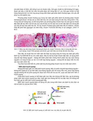 Giôùi thieäu moân hoïc Giaûi phaãu beänh 8
moâ phaûi ñöôïc coá ñònh, caét moûng 5 μm vaø nhuoäm maàu, thôøi gian chuaån bò maát khoaûng 3-4 ngaøy.
Quan saùt sieâu vi theå ñoøi hoûi maãu moâ phaûi ñöôïc caét moûng ñeán 0,1 μm, thôøi gian chuaån bò maát
haøng thaùng do ñoù ít coù tính öùng duïng trong chaån ñoaùn giaûi phaãu beänh thöôøng ngaøy, chuû yeáu ñeå
phuïc vuï cho nghieân cöùu.
Phöông phaùp nhuoäm thöôøng quy trong caùc laboâ giaûi phaãu beänh laø phöông phaùp nhuoäm
Hematoxylin-Eosin: teá baøo seõ coù nhaân baét maøu tím coøn baøo töông thì baét maøu hoàng (Hình 17A).
Trong moät soá tröôøng hôïp, coù theå duøng theâm caùc phöông phaùp nhuoäm hoaù moâ (coøn goïi laø nhuoäm
ñaëc bieät) ñeå xaùc ñònh moät soá caáu truùc cuûa teá baøo vaø moâ döïa vaøo aùi tính ñaëc bieät cuûa chuùng ñoái
vôùi moät soá loaïi hoaù chaát naøo ñoù. Thí duï nhuoäm Fontana giuùp phaùt hieän haéc toá melanin, nhuoäm
PAS ñeå phaùt hieän glycogen vaø chaát nhaày, nhuoäm Trichrome ñeå thaáy roõ sôïi collagen...(Hình 17
B,C)
Hình 17: Nieâm maïc ñaïi traøng nhuoäm Hematoxylin-Eosin (A); nhuoäm Trichrome, thaáy roõ maøng ñaùy baét maøu
xanh döông; nhuoäm PAS (periodic acid-Schiff), gioït chaát nhaày cuûa teá baøo ñaøi baét maàu hoàng.
Gaàn ñaây, kyõ thuaät hoaù moâ mieãn dòch ñaõ ñöôïc aùp duïng roäng raõi trong caùc laboâ giaûi phaãu
beänh taïi Tp.HCM ñeå hoã trôï cho chaån ñoaùn. Ñaây laø moät kyõ thuaät nhuoäm ñaëc bieät, söû duïng phaûn
öùng keát hôïp khaùng nguyeân - khaùng theå nhaèm phaùt hieän nhöõng thaønh phaàn caáu taïo (caùc khaùng
nguyeân) coù trong teá baøo vaø moâ. Vò trí keát hôïp khaùng nguyeân - khaùng theå seõ ñöôïc hieån thò nhôø
caùc hoaù chaát. (Hình 18)
Tuøy theo hoaù chaát hieån thò, phaân bieät hai phöông phaùp nhuoäm hoaù moâ mieãn dòch chính:
* Mieãn dòch huyønh quang:
Khaùng theå ñöôïc gaén vôùi chaát phaùt huyønh quang. Neáu coù phaûn öùng keát hôïp khaùng nguyeân -
khaùng theå (nghóa laø coù söï hieän dieän cuûa khaùng nguyeân caàn tìm trong maãu moâ), phöùc hôïp khaùng
nguyeân-khaùng theå seõ phaùt quang khi ñöôïc kích thích bôûi tia cöïc tím, quan saùt döôùi kính hieån vi
huyønh quang.
Chaát phaùt huyønh quang coù theå ñöôïc gaén tröïc tieáp vaøo khaùng theå ñaëc hieäu, goïi laø phöông
phaùp mieãn dòch huyønh quang tröïc tieáp; hoaëc gaén vaøo khaùng theå thöù hai ñaëc hieäu vôùi khaùng theå
thöù nhaát, goïi laø mieãn dòch huyønh quang giaùn tieáp.
Mieãn dòch huyønh quang ñöôïc söû duïng chuû yeáu trong chaån ñoaùn caùc beänh lyù caàu thaän vaø
moät soá beänh lyù cuûa da (Hình 19A).
Hình 18: Mieãn dòch huyønh quang vaø mieãn dòch men, tröïc tieáp (A) vaø giaùn tieáp (B)
 