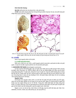 Beänh lyù heä hoâ haáp 152
Hình thaùi toån thöông:
Ñaïi theå: phoåi phình lôùn che laáp caû tim, maàu saéc lôït laït.
Vi theå: vaùch pheá nang bò phaù huûy nhöng khoâng coù phaûn öùng taïo moâ sôïi, caùc pheá nang saùt
nhaäp thaønh caùc tuùi khí lôùn. (Hình 21)
Hình 21: Khí pheá thuûng trung taâm tieåu thuyø (A, B), tieåu pheá quaûn hoâ haáp (*) bò phình giaõn trong khi caùc pheá
nang ôû ngoaïi vi tieåu thuøy vaãn coøn bình thöôøng; Khí pheá thuûng toaøn boä tieåu thuyø (C, D).
VI. U PHOÅI
Goàm 2 loaïi nguyeân phaùt vaø thöù phaùt.
A. U PHOÅI NGUYEÂN PHAÙT:
Goàm caùc u laønh vaø u aùc. 95% u phoåi nguyeân phaùt laø carcinoâm xuaát phaùt töø bieåu moâ pheá
quaûn, vì vaäy khi noùi ñeán ung thö phoåi laø noùi veà carcinoâm pheá quaûn.
1. CARCINOÂM PHEÁ QUAÛN (bronchogenic carcinoma):
Laø loaïi ung thö raát thöôøng gaëp, xaûy ra ôû giôùi nam nhieàu hôn nöõ. Keát quaû ghi nhaän ung thö
taïi Beänh vieän Ung böôùu Tp. HCM vaø Beänh vieän K Haø noäi (2004-2008) cho thaáy ung thö phoåi
cuøng ñöùng haøng thöù 1 ôû giôùi nam, haøng thöù 3 vaø 4 ôû giôùi nöõ. Ung thö phoåi thöôøng xaûy ra trong
ñoä tuoåi 40-70, ít thaáy tröôùc 40 tuoåi. Ung thö phoåi coù tieân löôïng raát xaáu do tính chaát aùc tính cuûa
noù, tæ leä soáng theâm 5 naêm chæ vaøo khoaûng 5-10%. Khi beänh ñöôïc chaån ñoaùn thì chæ coù khoaûng
15% tröôøng hôïp laø coøn moå ñöôïc.
Nguyeân nhaân:
Huùt thuoác laù laø nguyeân nhaân chính, coù moái lieân heä chaët cheõ giöõa soá ñieáu huùt moãi ngaøy,
caùch huùt vaø thôøi gian nghieän huùt vôùi nguy cô bò ung thö phoåi. Nguy cô ung thö phoåi ôû ngöôøi huùt
thuoác cao hôn ngöôøi khoâng huùt töø 10 -20 laàn. Trong hôn 1200 chaát ñöôïc tìm thaáy trong khoùi
thuoác, coù nhieàu chaát sinh ung nhö benzopyrene coù theå kích thích bieåu moâ pheá quaûn chuyeån saûn
gai vaø hình thaønh caùc toån thöông tieàn ung nhö nghòch saûn. (Hình 22)
Ngoaøi ra coøn coù moät soá taùc nhaân khaùc coù theå gaây ung thö phoåi ñaõ ñöôïc ghi nhaän nhö:
asbestos, chrome, nickel, caùc chaát phoùng xaï, caùc seïo phoåi cuõ.
 