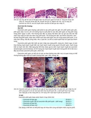 Beänh lyù heä hoâ haáp 153
Hình 22: Caùc thay ñoåi laàn löôït coù theå gaëp ôû bieåu moâ pheá quaûn ngöôøi huùt thuoác laù: Taêng saûn teá baøo tieát
nhaày (A); Taêng saûn teá baøo ñaùy (B); Chuyeån saûn gai (C); Nghòch saûn nheï, vöøa vaø naëng (D);
Carcinoâm taïi choã (E); sau ñoù chuyeån thaønh carcinoâm teá baøo gai xaâm nhaäp (F).
Hình thaùi toån thöông:
Ñaïi theå:
Carcinoâm pheá quaûn thöôøng xuaát phaùt töø caùc pheá quaûn lôùn gaàn roán phoåi (pheá quaûn goác,
pheá quaûn caáp 2 vaø 3); chæ 1/3 tröôøng hôïp laø xuaát phaùt töø caùc tieåu pheá quaûn vaø oáng pheá nang
trong phaàn ngoaïi vi phoåi. Toån thöông ban ñaàu coù daïng moät ñaùm saàn suøi goà cao treân beà maët
nieâm maïc hoaëc aên loeùt vaøo nieâm maïc pheá quaûn. Toån thöông lôùn daàn, taïo thaønh moät khoái u laøm
bít heïp loøng pheá quaûn, hoaëc xaâm nhieãm qua vaùch pheá quaûn vaøo moâ xung quanh pheá quaûn. U coù
maàu xaùm traéng, maät ñoä cöùng chaéc; neáu u quaù lôùn, coù theå coù xuaát huyeát hoaïi töû ôû giöõa taïo thaønh
hang.
Carcinoâm pheá quaûn tieán trieån seõ xaâm nhaäp vaøo maøng phoåi, maøng tim, thaønh ngöïc; di caên
theo ñöôøng maïch baïch huyeát ñeán caùc haïch baïch huyeát xung quanh khí-pheá quaûn, haïch trung
thaát vaø haïch treân ñoøn. Moät daïng ñaïi theå khaùc ñöôïc goïi laø vieâm maïch baïch huyeát do carcinoâm
(lymphangitis carcinomatosa), laø tình traïng caùc maïch baïch huyeát döôùi maøng phoåi noåi roõ leân do öù
ñaày caùc teá baøo carcinoâm pheá quaûn. (Hình 23)
Carcinoâm pheá quaûn coù theå cho di caên xa theo ñöôøng maùu ñeán moïi cô quan trong cô theå
nhöng thöôøng gaëp nhaát laø ôû tuyeán thöôïng thaän, gan ,naõo, xöông, da.
Hình 23: Carcinoâm pheá quaûn coù daïng choài suøi, gaây bít heïp loøng pheá quaûn (A); phaùt trieån xaâm nhaäp nhu moâ
phoåi xung quanh vaø di caên vaøo haïch döôùi chaïc ba pheá quaûn (B); u xuaát huyeát hoaïi töû taïo hang,
xaâm nhaäp gaây co keùo maøng phoåi (C); tình traïng vieâm maïch baïch huyeát do carcinoâm (D).
Vi theå:
Carcinoâm pheá quaûn ñöôïc phaân thaønh 4 loaïi (Hình 24):
- Carcinoâm teá baøo gai:
- Carcinoâm tuyeán (keå caû carcinoâm tieåu pheá quaûn - pheá nang)
- Carcinoâm teá baøo lôùn
- Carcinoâm teá baøo nhoû
: 25-30 %
: 30-35 %
: 10-15 %
: 20-25 %
Caùc daïng vi theå treân coù theå phoái hôïp vôùi nhau treân cuøng moät beänh nhaân ung thö phoåi.
 