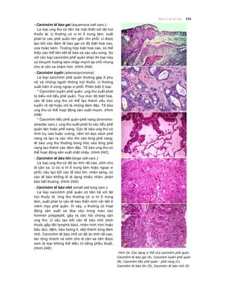 Beänh lyù heä hoâ haáp 154
- Carcinoâm teá baøo gai (squamous cell carc.):
Laø loaïi ung thö coù lieân heä maät thieát vôùi taät huùt
thuoác laù. U thöôøng coù vò trí ôû trung taâm, xuaát
phaùt töø caùc pheá quaûn lôùn gaàn roán phoåi. U ñöôïc
taïo bôûi caùc ñaùm teá baøo gai coù ñoä bieät hoaù cao,
vöøa hoaëc keùm. Tröôøng hôïp bieät hoaù cao, coù theå
thaáy caùc theå lieân keát teá baøo vaø caùc caàu söøng. So
vôùi caùc loaïi carcinoâm pheá quaûn khaùc thì loaïi naøy
coù khuynh höôùng xaâm nhaäp maïnh taïi choã nhöng
cho di caên xa chaäm hôn. (Hình 24A)
- Carcinoâm tuyeán (adenocarcinoma):
Laø loaïi carcinoâm pheá quaûn thöôøng gaëp ôû phuï
nöõ vaø nhöõng ngöôøi khoâng huùt thuoác. U thöôøng
xuaát hieän ôû vuøng ngoaïi vi phoåi. Phaân bieät 2 loaïi:
* Carcinoâm tuyeán pheá quaûn: ung thö xuaát phaùt
töø bieåu moâ tieåu pheá quaûn. Tuøy möùc ñoä bieät hoaù,
caùc teá baøo ung thö coù theå taïo thaønh caáu truùc
tuyeán roõ reät hoaëc chæ laø nhöõng ñaùm ñaëc. Teá baøo
ung thö coù theå hoaït ñoäng saûn xuaát mucin. (Hình
24B)
* Carcinoâm tieåu pheá quaûn-pheá nang (bronchio-
alveolar carc.): ung thö xuaát phaùt töø caùc tieåu pheá
quaûn taän hoaëc pheá nang. Caùc teá baøo ung thö coù
hình truï cao hoaëc vuoâng, naèm loùt doïc vaùch pheá
nang vaø taïo ra caùc nhuù thoø vaøo loøng pheá nang;
teá baøo ung thö thöôøng bong troùc vaøo loøng pheá
nang taïo thaønh caùc ñaùm ñaëc. Teá baøo ung thö coù
theå hoaït ñoäng saûn xuaát chaát nhaày. (Hình 24C)
- Carcinoâm teá baøo lôùn (large cell carc.):
Laø loaïi ung thö coù ñoä aùc tính raát cao, sôùm cho
di caên xa. U coù vò trí ôû trung taâm hoaëc ngoaïi vi
phoåi; caáu taïo bôûi caùc teá baøo lôùn, nhaân saùng, coù
caùc teá baøo khoång loà dò daïng nhieàu nhaân, phaân
baøo baát thöôøng. (Hình 24D)
- Carcinoâm teá baøo nhoû (small cell lung carc.):
Laø loaïi carcinoâm pheá quaûn coù lieân heä vôùi taät
huùt thuoác laù. Ung thö thöôøng coù vò trí ôû trung
taâm, xuaát phaùt töø caùc teá baøo thaàn kinh noäi tieát ôû
nieâm maïc pheá quaûn. Vì vaäy, u thöôøng coù hoaït
ñoäng saûn xuaát vaø ñöa vaøo trong maùu caùc
hormoân polypeùptít, gaây ra caùc hoäi chöùng caän
ung thö. U caáu taïo bôûi caùc teá baøo nhoû (kích
thöôùc gaáp ñoâi lymphoâ baøo), nhaân hình troøn hoaëc
baàu duïc, ñaäm, baøo töông ít, xeáp thaønh töøng ñaùm
nhoû. Carcinoâm teá baøo nhoû coù ñoä aùc tính raát cao,
lan roäng nhanh vaø sôùm cho di caên xa neân ñöôïc
xem laø loaïi khoâng theå ñieàu trò baèng phaãu thuaät.
(Hình 24E)
Hình 24: Caùc daïng vi theå cuûa carcinoâm pheá quaûn.
Carcinoâm teá baøo gai (A), Carcinoâm tuyeán pheá quaûn
(B), Carcinoâm tieåu pheá quaûn - pheá nang (C),
Carcinoâm teá baøo lôùn (D), Carcinoâm teá baøo nhoû (E)
 