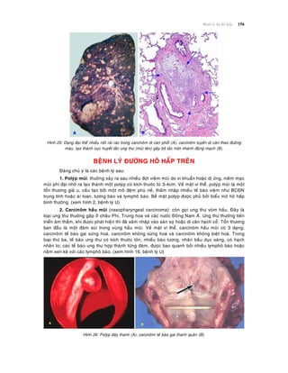 Beänh lyù heä hoâ haáp 156
Hình 25: Daïng ñaïi theå nhieàu noát raûi raùc trong carcinoâm di caên phoåi (A); carcinoâm tuyeán di caên theo ñöôøng
maùu, taïo thaønh cuïc huyeát taéc ung thö (muõi teân) gaây bít taéc moät nhaùnh ñoäng maïch (B).
BEÄNH LYÙ ÑÖÔØNG HOÂ HAÁP TREÂN
Ñaùng chuù yù laø caùc beänh lyù sau:
1. Polyùp muõi: thöôøng xaûy ra sau nhieàu ñôït vieâm muõi do vi khuaån hoaëc dò öùng, nieâm maïc
muõi phì ñaïi nhoâ ra taïo thaønh moät polyùp coù kích thöôùc töø 3-4cm. Veà maët vi theå, polyùp muõi laø moät
toån thöông giaû u, caáu taïo bôûi moät moâ ñeäm phuø neà, thaám nhaäp nhieàu teá baøo vieâm nhö BCÑN
trung tính hoaëc aùi toan, töông baøo vaø lymphoâ baøo. Beà maët polyùp ñöôïc phuû bôûi bieåu moâ hoâ haáp
bình thöôøng. (xem hình 2, beänh lyù U)
2. Carcinoâm haàu muõi (nasopharyngeal carcinoma): coøn goïi ung thö voøm haàu. Ñaây laø
loaïi ung thö thöôøng gaëp ôû chaâu Phi, Trung hoa vaø caùc nöôùc Ñoâng Nam AÙ. Ung thö thöôøng tieán
trieån aâm thaàm, khi ñöôïc phaùt hieän thì ñaõ xaâm nhaäp vaøo saøn soï hoaëc di caên haïch coå. Toån thöông
ban ñaàu laø moät ñaùm suøi trong vuøng haàu muõi. Veà maët vi theå, carcinoâm haàu muõi coù 3 daïng:
carcinoâm teá baøo gai söøng hoaù, carcinoâm khoâng söøng hoaù vaø carcinoâm khoâng bieät hoaù. Trong
loaïi thöù ba, teá baøo ung thö coù kích thöôùc lôùn, nhieàu baøo töông, nhaân baàu duïc saùng, coù haïch
nhaân to; caùc teá baøo ung thö hôïp thaønh töøng ñaùm, ñöôïc bao quanh bôûi nhieàu lymphoâ baøo hoaëc
naèm xen keõ vôùi caùc lymphoâ baøo. (xem hình 16, beänh lyù U)
Hình 26: Polyùp daây thanh (A); carcinoâm teá baøo gai thanh quaûn (B).
 