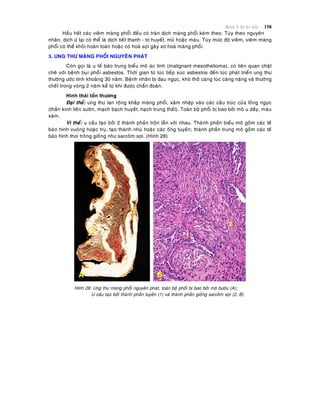 Beänh lyù heä hoâ haáp 158
Haàu heát caùc vieâm maøng phoåi ñeàu coù traøn dòch maøng phoåi keøm theo. Tuøy theo nguyeân
nhaân, dòch öù laïi coù theå laø dòch tieát thanh - tô huyeát, muû hoaëc maùu. Tuøy möùc ñoä vieâm, vieâm maøng
phoåi coù theå khoûi hoaøn toaøn hoaëc coù hoaù sôïi gaây xô hoaù maøng phoåi.
3. UNG THÖ MAØNG PHOÅI NGUYEÂN PHAÙT
Coøn goïi laø u teá baøo trung bieåu moâ aùc tính (malignant mesothelioma), coù lieân quan chaët
cheõ vôùi beänh buïi phoåi asbestos. Thôøi gian töø luùc tieáp xuùc asbestos ñeán luùc phaùt trieån ung thö
thöôøng öôùc tính khoaûng 30 naêm. Beänh nhaân bò ñau ngöïc, khoù thôû caøng luùc caøng naëng vaø thöôøng
cheát trong voøng 2 naêm keå töø khi ñöôïc chaån ñoaùn.
Hình thaùi toån thöông
Ñaïi theå: ung thö lan roäng khaép maøng phoåi, xaâm nhaäp vaøo caùc caáu truùc cuûa loàng ngöïc
(thaàn kinh lieân söôøn, maïch baïch huyeát, haïch trung thaát). Toaøn boä phoåi bò bao bôûi moâ u daày, maøu
xaùm.
Vi theå: u caáu taïo bôûi 2 thaønh phaàn troän laãn vôùi nhau. Thaønh phaàn bieåu moâ goàm caùc teá
baøo hình vuoâng hoaëc truï, taïo thaønh nhuù hoaëc caùc oáng tuyeán; thaønh phaàn trung moâ goàm caùc teá
baøo hình thoi troâng gioáng nhö sarcoâm sôïi. (Hình 28)
Hình 28: Ung thö maøng phoåi nguyeân phaùt, toaøn boä phoåi bò bao bôûi moâ böôùu (A);
U caáu taïo bôûi thaønh phaàn tuyeán (1) vaø thaønh phaàn gioáng sarcoâm sôïi (2, B)
 