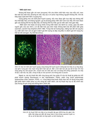 Giôùi thieäu moân hoïc Giaûi phaãu beänh 9
* Mieãn dòch men:
Khaùng theå ñöôïc gaén vôùi men (enzyme). Khi cho theâm chaát hieän maøu vaøo maãu moâ, men
laøm keát tuûa chaát maøu (thöôøng laø maàu naâu) taïi vò trí phöùc hôïp khaùng nguyeân-khaùng theå, nhôø ñoù
thaáy ñöôïc döôùi kính hieån vi quang hoïc.
Cuõng gioáng nhö vôùi chaát phaùt huyønh quang, neáu men ñöôïc gaén tröïc tieáp vaøo khaùng theå
thöù nhaát ñaëc hieäu vôùi khaùng nguyeân, goïi laø phöông phaùp mieãn dòch men tröïc tieáp. Khi men ñöôïc
gaén vaøo khaùng theå thöù hai ñaëc hieäu vôùi khaùng theå thöù nhaát, goïi laø mieãn dòch men giaùn tieáp.
- Mieãn dòch men ñöôïc söû duïng nhieàu trong chaån ñoaùn caùc beänh lyù u böôùu, giuùp xaùc ñònh
nguoàn goác cuûa caùc khoái u coù ñoä bieät hoaù quaù keùm hoaëc khoâng bieät hoaù ñeå phaân bieät giöõa
carcinoâm, sarcoâm hay limphoâm (Hình 19B). Trong moät soá tröôøng hôïp, chaúng haïn ñoái vôùi ung thö
vuù, mieãn dòch men coøn coù giaù trò ñaùnh giaù tieân löôïng vaø ñaùp öùng ñieàu trò (ñaùnh giaù tình traïng thuï
theå noäi tieát estrogen, thuï theå Her-2/neu).
Hình 19: Hoaù moâ mieãn dòch huyønh quang, duøng khaùng theå huyønh quanh choáng IgA cho thaáy coù söï laéng ñoïng
cuûa IgA ôû vuøng gian mao maïch trong beänh thaän IgA (A). Moät u keùm bieät hoaù caáu taïo bôûi teá baøo hình thoi
troâng gioáng nhö moät sarcoâm (B1), nhuoäm hoaù moâ mieãn dòch men vôùi khaùng theå choáng cytokeratin cho thaáùy
teá baøo u baét maàu naâu (B2), chöùng toû ñaây laø moät carcinoâm chöù khoâng phaûi laø sarcoâm.
Ngoaøi ra, caùc kyõ thuaät tieân tieán öùng duïng sinh hoïc phaân töû nhö kyõ thuaät lai gheùp taïi choã
phaùt huyønh quang (fluorescent in situ hybridization, FISH), phaûn öùng chuoãi polymerase
(polymerase chain reaction, PCR), v.v. cuõng ñang töøng böôùc ñöôïc ñöa vaøo söû duïng trong laboâ
giaûi phaãu beänh nhaèm phuïc vuï cho coâng taùc chaån ñoaùn; caùc kyõ thuaät naøy tuy coù ñoä chính xaùc
cao nhöng chi phí cuõng cao khoâng keùm! (Hình 20).
Hình 20: Kyõ thuaät FISH cho thaáy coù söï khuyeách ñaïi gen HER-2/neu leân gaáp 3 laàn
(bieåu hieän baèng caùc ñoám ñoû trong nhaân) ôû caùc teá baøo carcinoâm tuyeán vuù
(B) so vôùi teá baøo bieåu moâ oáng tuyeán vuù bình thöôøng (A).
 
