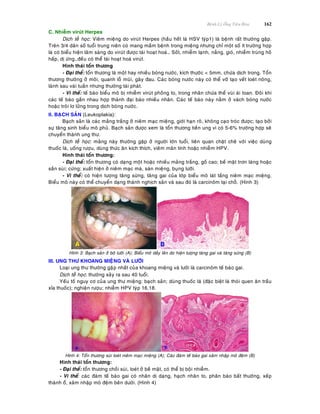 Beänh Lyù OÁng Tieâu Hoùa 162
C. Nhieãm viruùt Herpes
Dòch teã hoïc: Vieâm mieäng do viruùt Herpes (haàu heát laø HSV tyùp1) laø beänh raát thöôøng gaëp.
Treân 3/4 daân soá tuoåi trung nieân coù mang maàm beänh trong mieäng nhöng chæ moät soá ít tröôøng hôïp
laø coù bieåu hieän laâm saøng do viruùt ñöôïc taùi hoaït hoaù… Soát, nhieãm laïnh, naéng, gioù, nhieãm truøng hoâ
haáp, dò öùng…ñeàu coù theå taùi hoaït hoaù viruùt.
Hình thaùi toån thöông
- Ñaïi theå: toån thöông laø moät hay nhieàu boùng nöôùc, kích thöôùc < 5mm, chöùa dòch trong. Toån
thöông thöôøng ôû moâi, quanh loã muõi, gaây ñau. Caùc boùng nöôùc naøy coù theå vôõ taïo veát loeùt noâng,
laønh sau vaøi tuaàn nhöng thöôøng taùi phaùt.
- Vi theå: teá baøo bieåu moâ bò nhieãm viruùt phoàng to, trong nhaân chöùa theå vuøi aùi toan. Ñoâi khi
caùc teá baøo gaàn nhau hôïp thaønh ñaïi baøo nhieàu nhaân. Caùc teá baøo naøy naèm ôû vaùch boùng nöôùc
hoaëc troâi lô löûng trong dòch boùng nöôùc.
II. BAÏCH SAÛN (Leukoplakia):
Baïch saûn laø caùc maûng traéng ôû nieâm maïc mieäng, giôùi haïn roõ, khoâng caïo troùc ñöôïc; taïo bôûi
söï taêng sinh bieåu moâ phuû. Baïch saûn ñöôïc xem laø toån thöông tieàn ung vì coù 5-6% tröôøng hôïp seõ
chuyeån thaønh ung thö.
Dòch teã hoïc: maûng naøy thöôøng gaëp ôû ngöôøi lôùn tuoåi, lieân quan chaët cheõ vôùi vieäc duøng
thuoác laù, uoáng röôïu, duøng thöùc aên kích thích, vieâm maõn tính hoaëc nhieãm HPV.
Hình thaùi toån thöông:
- Ñaïi theå: toån thöông coù daïng moät hoaëc nhieàu maûng traéng, goà cao; beà maët trôn laùng hoaëc
saàn suøi; cöùng; xuaát hieän ôû nieâm maïc maù, saøn mieäng, buïng löôõi.
- Vi theå: coù hieän töôïng taêng söøng, taêng gai cuûa lôùp bieåu moâ laùt taàng nieâm maïc mieäng.
Bieåu moâ naøy coù theå chuyeån daïng thaønh nghòch saûn vaø sau ñoù laø carcinoâm taïi choã. (Hình 3)
Hình 3: Baïch saûn ôû bôø löôõi (A); Bieåu moâ daày leân do hieän töôïng taêng gai vaø taêng söøng (B)
III. UNG THÖ KHOANG MIEÄNG VAØ LÖÔÕI
Loaïi ung thö thöôøng gaêïp nhaát cuûa khoang mieäng vaø löôõi laø carcinoâm teá baøo gai.
Dòch teã hoïc: thöôøng xaûy ra sau 40 tuoåi.
Yeáu toá nguy cô cuûa ung thö mieäng: baïch saûn; duøng thuoác laù (ñaëc bieät laø thoùi quen aên traàu
xæa thuoác); nghieän röôïu; nhieãm HPV tyùp 16,18.
Hình 4: Toån thöông suøi loeùt nieâm maïc mieäng (A); Caùc ñaùm teá baøo gai xaâm nhaäp moâ ñeäm (B)
Hình thaùi toån thöông:
- Ñaïi theå: toån thöông choài suøi, loeùt ôû beà maët, coù theå bò boäi nhieãm.
- Vi theå: caùc ñaùm teá baøo gai coù nhaân dò daïng, haïch nhaân to, phaân baøo baát thöôøng, xeáp
thaønh oå, xaâm nhaäp moâ ñeäm beân döôùi. (Hình 4)
 