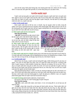 Beänh Lyù OÁng Tieâu Hoùa 163
Lieân heä laâm saøng: Khôûi phaùt khoâng ñau neân thöôøng phaùt hieän treã, nhaát laø khi toån thöông
naèm ôû 1/3 sau löôõi; laøm giaûm keát quaû ñieàu trò vaø khaû naêng soáng coøn cuûa beänh nhaân.
TUYEÁN NÖÔÙC BOÏT
Tuyeán nöôùc boït bao goàm caùc tuyeán chính laø tuyeán mang tai, tuyeán döôùi haøm vaø tuyeán döôùi
löôõi, ngoaøi ra coøn coù caùc tuyeán nöôùc boït phuï naèm raûi raùc trong nieâm maïc mieäng vaø nieâm maïc
voøm khaåu caùi. Beänh lyù tuyeán nöôùc boït hay gaëp ôû tuyeán mang tai. Hai loaïi beänh lyù thöôøng gaëp
nhaát laø laø vieâm vaø u tuyeán nöôùc boït.
I. VIEÂM TUYEÁN NÖÔÙC BOÏT
Vieâm tuyeán nöôùc boït coù theå do viruùt, vi khuaån, hay do nguyeân nhaân töï mieãn; trong ñoù
nhieãm viruùt quai bò (paramyxovirus) laø nguyeân nhaân thöôøng gaëp nhaát. Beänh quai bò ôû treû em coù
toån thöông giôùi haïn ôû tuyeán nöôùc boït; traùi laïi ôû ngöôøi tröôûng thaønh thì coù theå bò bieán chöùng vieâm
tuïy vaø vieâm tinh hoaøn (daãn ñeán voâ sinh veà sau).
A. Vieâm tuyeán nöôùc boït do viruùt quai bò
Hình thaùi toån thöông:
- Ñaïi theåå: Paramyxovirus gaây söng to toaøn
boä caùc tuyeán chính, ñaëc bieät laø tuyeán mang tai.
- Vi theå: Paramyxovirus thöôøng gaây vieâm
moâ keõ lan toûa, phuø vaø thaám nhaäp teá baøo ñôn
nhaân; ñoâi khi coù caùc oå hoaïi töû.
B. Vieâm tuyeán nöôùc boït do cô cheá töï mieãn
trong hoäi chöùng Sjögren thì haàu nhö luoân taán
coâng hai beân. Taát caû tuyeán nöôùc boït (chính vaø
phuï), tuyeán leä ñeàu bò toån thöông, gaây ra chöùng
khoâ mieäng vaø khoâ maét (vieâm keát - giaùc maïc
khoâ)
Hình 5: Vieâm tuyeán nöôùc boït maïn tính do taéc oáng
daãn. Moät soá nang tuyeán bò teo, moâ ñeäm
thaám nhaäp lymphoâ baøo vaø töông baøo.
C. Vieâm tuyeán nöôùc boït do vi khuaån thöôøng xaûy ra thöù phaùt sau taéc oáng tuyeán do soûi (Hình 5).
Vi khuaån gaây beänh thöôøng gaëp nhaát laø Staphylococcus aureus vaø Streptococcus viridans. Phaûn
öùng vieâm xaûy ra trong moâ keõ, coù theå gaây hoaïi töû hoùa muû, hình thaønh oå aùp-xe.
II. U TUYEÁN NÖÔÙC BOÏT
Dòch teã hoïc: noùi chung, u tuyeán nöôùc boït töông ñoái ít gaëp, chieám khoâng quaù 2% caùc loaïi u ôû
ngöôøi. Tæ leä nam nöõ maéc beänh nhö nhau; xaûy ra ôû ngöôøi lôùn nhieàu hôn treû em. U thöôøng xuaát
hieän ôû tuyeán mang tai, chieám 65-80% tröôøng hôïp, trong ñoù coù khoaûng 15% laø aùc tính; 10% u
xaûy ra ôû tuyeán döôùi haøm trong ñoù coù 40% laø aùc tính; soá ít coøn laïi xuaát hieän ôû tuyeán nöôùc boït
döôùi löôõi vaø caùc tuyeán nöôùc boït phuï nhöng quaù nöûa laø u aùc. Nhö vaäy, tæ leä u aùc tính cuûa u tuyeán
nöôùc boït tæ leä nghòch vôùi kích thöôùc tuyeán.
Daïng ñaïi theå thöôøng thaáy laø 1 khoái u ôû tröôùc tai, thöôøng di ñoäng khi sôø naén, kích thöôùc töø 4-
6cm. Chæ coù theå chaån ñoaùn phaân bieät laønh aùc moät caùch chaéc chaén baèng khaûo saùt moâ beänh hoïc.
Hai loaïi u laønh tuyeán nöôùc boït thöôøng gaëp laø u tuyeán ña daïng vaø u Warthin. Loaïi u aùc nguyeân
phaùt thöôøng gaëp nhaát cuûa tuyeán nöôùc boït laø carcinoâm nhaày bì.
A. U tuyeán ña daïng (pleomorphic adenoma, mixed tumor):
Coøn goïi laø u hoãn hôïp, laø u laønh thöôøng gaëp ôû tuyeán mang tai.
Hình thaùi toån thöông:
- Ñaïi theå: u laønh, phaùt trieån chaäm, kích thöôùc < 6 cm. bôø töông ñoái roõ, coù voû bao sôïi, beà
maët trôn laùng
- Vi theå: u ñöôïc ñaëc tröng bôûi söï ña daïng veà thaønh phaàn caáu taïo. Thaønh phaàn bieåu moâ
goàm caùc teá baøo nhoû hình troøn hoaëc hình thoi, saép xeáp thaønh caáu truùc oáng, tuùi, daây, ñaùm ñaëc.
Thaønh phaàn bieåu moâ hoøa troän vôùi moâ ñeäm daïng nieâm, loûng leûo, ñoâi khi chöùa caùc ñaûo daïng suïn
hoaëc xöông. Baèng chöùng hoùa moâ mieãn dòch cho thaáy taát caû caùc loaïi teá baøo khaùc nhau naøy trong
u ñeàu xuaát phaùt töø teá baøo cô bieåu moâ. (Hình 6)
 