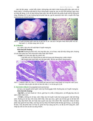 Beänh Lyù OÁng Tieâu Hoùa 164
Lieân heä laâm saøng: u phaùt trieån chaäm, khoâng ñau neân beänh nhaân thöôøng ñeå nhieàu naêm môùi ñi
khaùm beänh. U thöôøng xuaát phaùt töø thuyø noâng tuyeán mang tai, taïo ra moät khoái phoàng ôû goùc haøm
sôø thaáy deã daøng. U coù voû bao khoâng hoaøn toaøn neân deã taùi phaùt neáu phaãu thuaät caét boû khoâng ñuû
roäng. Khoaûng 2-3 % caùc tröôøng hôïp taùi phaùt hoaù aùc, goïi laø carcinoâm treân neàn u tuyeán hoãn hôïp
(carcinoma ex mixed tumors).
Hình 6 : U tuyeán ña daïng tuyeán nöôùc boït coù giôùi haïn roõ (A). Caáu taïo vi theå goàm nhieàu thaønh phaàn nhö caùc
oáng tuyeán (1), moâ ñeäm daïng nieâm (2) (B).
B. U Warthin
Laø u laønh, haàu nhö chæ xuaát hieän ôû tuyeán mang tai.
Hình thaùi toån thöông:
- Ñaïi theå: thöôøng laø khoái nhoû, troøn hay baàu duïc, coù voû bao, maët caét maàu traéng xaùm, thöôøng
coù caùc khe hoaëc boïc nhoû chöùa dòch nhaày hoaëc dòch thanh.
- Vi theå: coù 2 hình aûnh ñaëc thuø (Hình 7A):
* Lôùp bieåu moâ coù 2 lôùp teá baøo aùi toan loùt trong caùc khoang boïc, phaân nhaùnh.
* Moâ limphoâ beân döôùi bieåu moâ raát phaùt trieån, ñoâi khi taïo thaønh nang limphoâ.
Hình 7: U Warthin: bieåu moâ 2 lôùp (1),i moâ limphoâ beân döôùi taïo thaønh nang limphoâ vôùi trung taâm maàm (2)(A)
Carcinoâm nhaày bì goàm caùc ñaùm teá baøo tieát nhaày (1) vaø teá baøo gai (2) (B).
C. Carcinoâm nhaày bì (mucoepidermoid carcinoma):
Laø loaïi u aùc nguyeân phaùt tuyeán nöôùc boït thöôøng gaëp nhaát, thöôøng xaûy ra ôû tuyeán mang tai.
Hình thaùi toån thöông:
- Ñaïi theå: u coù kích thöôùc töø 1-8 cm, giôùi haïn roõ, chaéc, di ñoäng keùm, coù theå gaây ñau neáu coù
xaâm nhieãm thaàn kinh.
- Vi theå: u khoâng coù voû bao, xaâm nhaäp vaøo moâ tuyeán nöôùc boït xung quanh; maët caét traéng
xaùm, thöôøng coù vaøi boïc nhoû chöùa chaát nhaày. Caáu taïo cuûa u goàm caùc teá baøo gai vaø teá baøo tieát
nhaày, saép xeáp thaønh daûi, beø hoaëc bao quanh caùc boïc nhoû (Hình 7B). Carcinoâm nhaày bì ñöôïc
phaân loaïi grad moâ hoïc thaáp, vöøa hay cao tuøy theo tæ leä thaønh phaàn teá baøo gai trong u, söï dò daïng
teá baøo, möùc ñoä phaân baøo vaø hoaïi töû; grad moâ hoïc caøng cao thì u coù ñoä aùc tính caøng lôùn, xaâm
nhaäp taïi choã vaø cho di caên xa caøng nhanh.
 