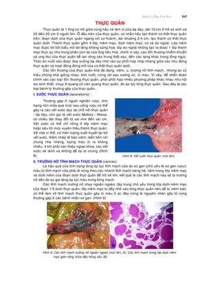 Beänh Lyù OÁng Tieâu Hoùa 165
THÖÏC QUAÛN
Thöïc quaûn laø 1 oáng cô noái giöõa vuøng haàu vaø taâm vò cuûa daï daøy, daøi 10 cm ôû treû sô sinh vaø
23 ñeán 25 cm ôû ngöôøi lôùn. ÔÛ ñaàu treân cuûa thöïc quaûn, cô nhaãn haàu taïo thaønh cô thaét thöïc quaûn
treân; ñoaïn döôùi cuûa thöïc quaûn ngang vôùi cô hoaønh, daøi khoaûng 2-4 cm, taïo thaønh cô thaét thöïc
quaûn döôùi. Thaønh thöïc quaûn goàm 4 lôùp: nieâm maïc, döôùi nieâm maïc, cô vaø aùo ngoaøi. Lôùp nieâm
maïc ñöôïc loùt bôûi bieåu moâ laùt taàng khoâng söøng hoaù; lôùp aùo ngoaøi khoâng taïo ra ñöôïc 1 lôùp thanh
maïc thöïc söï nhö trong phaàn coøn laïi cuûa oáng tieâu hoaù, chính vì vaäy, caùc toån thöông nhieãm khuaån
vaø ung thö cuûa thöïc quaûn deã lan roäng vaøo trung thaát sau, ñeán caùc taïng khaùc trong loàng ngöïc.
Thöùc aên nuoát vaøo ñöôïc ñöa xuoáng daï daøy nhôø vaøo söï phoái hôïp nhòp nhaøng giöõa caùc nhu ñoäng
thöïc quaûn vaø hoaït ñoäng ñoùng môû cuûa cô thaét thöïc quaûn döôùi.
Caùc toån thöông cuûa thöïc quaûn khaù ña daïng: vieâm, u, tröôùng nôû tónh maïch… nhöng laïi coù
trieäu chöùng khaù gioáng nhau: khoù nuoát, noùng raùt sau xöông öùc, oùi maùu. Vì vaäy, ñeå chaån ñoaùn
chính xaùc caùc loaïi toån thöông thöïc quaûn, phaûi phoái hôïp nhieàu phöông phaùp khaùc nhau nhö noäi
soi sinh thieát, chuïp X-quang coù caûn quang thöïc quaûn, ño aùp löïc loøng thöïc quaûn. Sau ñaây laø caùc
loaïi beänh lyù thöôøng gaëp cuûa thöïc quaûn.
I. XÖÔÙC THÖÏC QUAÛN (lacerations) :
Thöôøng gaëp ôû ngöôøi nghieän röôïu, tình
traïng noân möûa quaù möùc sau uoáng röôïu coù theå
gaây ra caùc veát xöôùc doïc taïi choã noái thöïc quaûn
- daï daøy, coøn goïi laø veát xöôùc Mallory - Weiss,
coù chieàu daøi thay ñoåi töø vaøi mm ñeán vaøi cm.
Veát xöôùc coù theå chæ noâng ôû lôùp nieâm maïc
hoaëc saâu tôùi möùc xuyeân thaáu thaønh thöïc quaûn.
Veà maët vi theå, coù hieän töôïng xuaát huyeát taïi bôø
veát xöôùc, thaám nhaäp teá baøo vieâm; dieãn tieán noùi
chung nheï nhaøng, löôïng maùu oùi ra khoâng
nhieàu, ít khi phaûi can thieäp ngoaïi khoa; caùc veát
xöôùc seõ laønh vaø khoâng ñeå laïi di chöùng (Hình
8). Hình 8: Veát xöôùc thöïc quaûn (muõi teân)
II. TRÖÔÙNG NÔÛ TÓNH MAÏCH THÖÏC QUAÛN (varices):
Laø haäu quaû cuûa tình traïng taêng aùp löïc tónh maïch cöûa do xô gan (chuû yeáu laø xô gan röôïu);
maùu töø tónh maïch cöûa phaûi ñi voøng theo caùc nhaùnh tónh maïch baøng heä, naèm trong lôùp nieâm maïc
vaø döôùi nieâm cuûa ñoaïn döôùi thöïc quaûn ñeå trôû veà tim, keát quaû laø caùc tónh maïch naøy seõ bò tröôùng
nôû daàn do söï gia taêng aùp löïc maùu trong loøng maïch.
Caùc tónh maïch tröôùng nôû chaïy ngoaèn ngoeøo, taäp trung chuû yeáu trong lôùp döôùi nieâm maïc
cuûa ñoaïn 1/3 döôùi thöïc quaûn; lôùp nieâm maïc bò ñaåy nhoâ vaøo loøng thöïc quaûn neân deã bò vieâm loeùt,
coù theå laøm vôõ tónh maïch thöïc quaûn gaây oùi maùu oà aït; ñaây cuõng laø nguyeân nhaân gaây töû vong
thöôøng gaëp ôû caùc beänh nhaân xô gan. (Hình 9)
Hình 9: Caùc tónh maïch tröôùng nôû ngoaèn ngoeøo (muõi teân, A); Caùc tónh maïch trong lôùp döôùi nieâm
maïc giaõn roäng chöùa ñaày hoàng caàu (B)
 