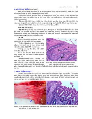 Beänh Lyù OÁng Tieâu Hoùa 166
III. VIEÂM THÖÏC QUAÛN (esophagitis):
Vieâm thöïc quaûn laø moät beänh lyù raát thöôøng gaëp ôû ngöôøi lôùn nhöng ít thaáy ôû treû em. Vieâm
thöïc quaûn coù theå do nhieàu nguyeân nhaân khaùc nhau:
- Traøo ngöôïc dòch vò leân thöïc quaûn: laø nguyeân nhaân haøng ñaàu, dòch vò coù tính acid laøm toån
thöông nieâm maïc thöïc quaûn, gaây ra tình traïng vieâm thöïc quaûn (vieâm thöïc quaûn traøo ngöôïc)
(reflux esophagitis)
- Caùc taùc nhaân kích thích nhö ñaët oáng thoâng daï daøy quaù laâu; duøng caùc chaát kích thích nhö
röôïu, caùc dung dòch acid hoaëc kieàm, thöùc uoáng quaù noùng, caùc hoaù chaát ñieàu trò ung thö, tia xaï…
- Caùc taùc nhaân nhieãm truøng nhö vi khuaån, viruùt (HSV…), naám.
Hình thaùi toån thöông:
- Ñaïi theå: thay ñoåi tuyø loaïi vieâm thöïc quaûn, thôøi gian vaø möùc ñoä taùc ñoäng cuûa taùc nhaân
gaây vieâm. Ñoái vôùi vieâm thöïc quaûn traøo ngöôïc; neáu vieâm nheï, chæ thaáy nieâm maïc thöïc quaûn sung
huyeát hôi ñoû; tröôøng hôïp vieâm naëng, nieâm maïc coù theå bò loeùt, hoaïi töû, xuaát huyeát, hình thaønh moâ
haït vieâm vaø hoaù xô gaây heïp loøng thöïc quaûn.
- Vi theå:
Trong tröôøng hôïp vieâm thöïc quaûn traøo
ngöôïc möùc ñoä nheï, coù 3 hieän töôïng sau:
* Thaám nhaäp caùc teá baøo vieâm trong lôùp
bieåu moâ nhö baïch caàu ña nhaân aùi toan (xuaát
hieän sôùm nhaát), BCÑNTT, limphoâ baøo.
* Taêng saûn lôùp ñaùy bieåu moâ (>20%
chieàu daøy bieåu moâ).
* Caùc nhuù cuûa moâ ñeäm nieâm maïc bò
sung huyeát, nhoâ cao ñeán 1/3 treân lôùp bieåu
moâ (Hình 10).
Lieân heä laâm saøng: Trieäu chöùng cuûa
vieâm thöïc quaûn thay ñoåi tuyø theo möùc ñoä
vieâm, goàm coù ôï chua, caûm giaùc noùng raùt sau
xöông öùc, khoù nuoát, oùi maùu, ñi caàu phaân ñen.
H.10: Taêng saûn lôùp ñaùy bieåu moâ (muõi teân daøi) vaø
thaám nhaäp baïch caàu aùi toan (ñaàu muõi teân)
Vieâm thöïc quaûn traøo ngöôïc keùo daøi coù theå daãn ñeán thöïc quaûn Barrett cuøng vôùi nguy cô hoaù aùc
cuûa noù.
IV. THÖÏC QUAÛN BARRETT
Laø bieán chöùng cuûa tình traïng traøo ngöôïc keùo daøi cuûa dòch vò leân thöïc quaûn. Trong thöïc
quaûn Barrett, lôùp bieåu moâ laùt taàng khoâng söøng hoùa bình thöôøng ôû ñoaïn döôùi thöïc quaûn ñöôïc
chuyeån saûn thaønh bieåu moâ truï tieát nhaày (kieåu daï daøy - ruoät), coù leõ ñeå thích nghi toát hôn vôùi moâi
tröôøng acid gaây neân bôûi söï traøo ngöôïc dòch vò.
Hình 11: Vuøng nieâm maïc ñoû möôït cuûa thöïc quaûn Barrett (A) Bieåu moâ laùt taàng cuûa thöïc quaûn ñöôïc thay theá
bôûi bieåu moâ truï kieåu daï daøy - ruoät.
 