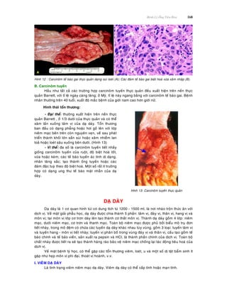 Beänh Lyù OÁng Tieâu Hoùa 168
Hình 12 : Carcinoâm teá baøo gai thöïc quaûn daïng suøi loeùt (A); Caùc ñaùm teá baøo gai bieät hoaù vöøa xaâm nhaäp (B).
B. Carcinoâm tuyeán
Haàu nhö taát caû caùc tröôøng hôïp carcinoâm tuyeán thöïc quaûn ñeàu xuaát hieän treân neàn thöïc
quaûn Barrett, vôùi tæ leä ngaøy caøng taêng; ôû Myõ, tæ leä naøy ngang baèng vôùi carcinoâm teá baøo gai. Beänh
nhaân thöôøng treân 40 tuoåi, xuaát ñoä maéc beänh cuûa giôùi nam cao hôn giôùi nöõ.
Hình thaùi toån thöông:
- Ñaïi theå: thöôøng xuaát hieän treân neàn thöïc
quaûn Barrett , ôû 1/3 döôùi cuûa thöïc quaûn vaø coù theå
xaâm laán xuoáng taâm vò cuûa daï daøy. Toån thöông
ban ñaàu coù daïng phaúng hoaëc hôi goà leân vôùi lôùp
nieâm maïc beân treân coøn nguyeân veïn, veà sau phaùt
trieån thaønh khoái lôùn saàn suøi hoaëc xaâm nhieãm lan
toaû hoaëc loeùt saâu xuoáng beân döôùi. (Hình 13)
- Vi theå: ña soá laø carcinoâm tuyeán tieát nhaày
gioáng carcinoâm tuyeán cuûa ruoät, ñoä bieät hoaù toát,
vöøa hoaëc keùm; caùc teá baøo tuyeán aùc tính dò daïng,
nhaân taêng saéc; taïo thaønh oáng tuyeán hoaëc caùc
ñaùm ñaëc tuyø theo ñoä bieät hoaù. Moät soá raát ít tröôøng
hôïp coù daïng ung thö teá baøo maët nhaãn cuûa daï
daøy.
Hình 13: Carcinoâm tuyeán thöïc quaûn
DAÏ DAØY
Daï daøy laø 1 cô quan hình tuùi coù dung tích töø 1200 - 1500 ml, laø nôi nhaøo troän thöùc aên vôùi
dòch vò. Veà maët giaûi phaãu hoïc, daï daøy ñöôïc chia thaønh 5 phaàn: taâm vò, ñaùy vò, thaân vò, hang vò vaø
moân vò; taïi moân vò lôùp cô trôn daøy leân taïo thaønh cô thaét moân vò. Thaønh daï daøy goàm 4 lôùp: nieâm
maïc, döôùi nieâm maïc, cô trôn vaø thanh maïc. Toaøn boä nieâm maïc ñöôïc phuû bôûi bieåu moâ truï ñôn
tieát nhaøy, trong moâ ñeäm coù chöùa caùc tuyeán daï daøy khaùc nhau tuøy vuøng, goàm 3 loaïi: tuyeán taâm vò
vaø tuyeán hang - moân vò tieát nhaøy; tuyeán vò phaân boá trong vuøng ñaùy vò vaø thaân vò, caáu taïo goàm teá
baøo chính vaø teá baøo vieàn, saûn xuaát ra pepsin vaø HCl, laø thaønh phaàn chính cuûa dòch vò. Toaøn boä
chaát nhaøy ñöôïc tieát ra seõ taïo thaønh haøng raøo baûo veä nieâm maïc choáng laïi taùc ñoäng tieâu hoaù cuûa
dòch vò.
Veà maët beänh lyù hoïc, coù theå gaëp caùc toån thöông vieâm, loeùt, u vaø moät soá dò taät baåm sinh ít
gaëp nhö heïp moân vò phì ñaïi, thoaùt vò hoaønh, v.v.
I. VIEÂM DAÏ DAØY
Laø tình traïng vieâm nieâm maïc daï daøy. Vieâm daï daøy coù theå caáp tính hoaëc maïn tính.
 