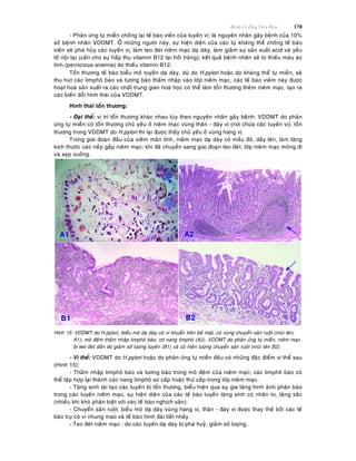 Beänh Lyù OÁng Tieâu Hoùa 170
- Phaûn öùng töï mieãn choáng laïi teá baøo vieàn cuûa tuyeán vò: laø nguyeân nhaân gaây beänh cuûa 10%
soá beänh nhaân VDDMT. ÔÛ nhöõng ngöôøi naøy, söï hieän dieän cuûa caùc töï khaùng theå choáng teá baøo
vieàn seõ phaù huûy caùc tuyeán vò, laøm teo ñeùt nieâm maïc daï daøy, laøm giaûm söï saûn xuaát acid vaø yeáu
toá noäi taïi (caàn cho söï haáp thuï vitamin B12 taïi hoài traøng); keát quaû beänh nhaân seõ bò thieáu maùu aùc
tính (pernicious anemia) do thieáu vitamin B12.
Toån thöông teá baøo bieåu moâ tuyeán daï daøy, duø do H.pylori hoaëc do khaùng theå töï mieãn, seõ
thu huùt caùc limphoâ baøo vaø töông baøo thaám nhaäp vaøo lôùp nieâm maïc, caùc teá baøo vieâm naøy ñöôïc
hoaït hoaù saûn xuaát ra caùc chaát trung gian hoaù hoïc coù theå laøm toån thöông theâm nieâm maïc, taïo ra
caùc bieán ñoåi hình thaùi cuûa VDDMT.
Hình thaùi toån thöông:
- Ñaïi theå: vò trí toån thöông khaùc nhau tuøy theo nguyeân nhaân gaây beänh: VDDMT do phaûn
öùng töï mieãn coù toån thöông chuû yeáu ôû nieâm maïc vuøng thaân - ñaùy vò (nôi chöùa caùc tuyeán vò); toån
thöông trong VDDMT do H.pylori thì laïi ñöôïc thaáy chuû yeáu ôû vuøng hang vò.
Trong giai ñoaïn ñaàu cuûa vieâm maõn tính, nieâm maïc daï daøy coù maàu ñoû, daày leân, laøm taêng
kích thöôùc caùc neáp gaáp nieâm maïc; khi ñaõ chuyeån sang giai ñoaïn teo ñeùt, lôùp nieâm maïc moûng ñi
vaø xeïp xuoáng.
Hình 15: VDDMT do H.pylori, bieåu moâ daï daøy coù vi khuaån treân beà maët, coù vuøng chuyeån saûn ruoät (muõi teân,
A1); moâ ñeäm thaám nhaäp limphoâ baøo, coù nang limphoâ (A2). VDDMT do phaûn öùng töï mieãn, nieâm maïc
bò teo ñeùt daàn do giaûm soá löôïng tuyeán (B1) vaø coù hieän töôïng chuyeån saûn ruoät (muõi teân B2).
- Vi theå: VDDMT do H.pylori hoaëc do phaûn öùng töï mieãn ñeàu coù nhöõng ñaëc ñieåm vi theå sau
(Hình 15):
- Thaám nhaäp limphoâ baøo vaø töông baøo trong moâ ñeäm cuûa nieâm maïc; caùc limphoâ baøo coù
theå taäp hôïp laïi thaønh caùc nang limphoâ sô caáp hoaëc thöù caáp trong lôùp nieâm maïc.
- Taêng sinh taùi taïo caùc tuyeán bò toån thöông, bieåu hieän qua söï gia taêng hình aûnh phaân baøo
trong caùc tuyeán nieâm maïc, söï hieän dieän cuûa caùc teá baøo tuyeán taêng sinh coù nhaân to, taêng saéc
(nhieàu khi khoù phaân bieät vôùi caùc teá baøo nghòch saûn).
- Chuyeån saûn ruoät: bieåu moâ daï daøy vuøng hang vò, thaân - ñaùy vò ñöôïc thay theá bôûi caùc teá
baøo truï coù vi nhung mao vaø teá baøo hình ñaøi tieát nhaày.
- Teo ñeùt nieâm maïc : do caùc tuyeán daï daøy bò phaù huyû, giaûm soá löôïng.
 