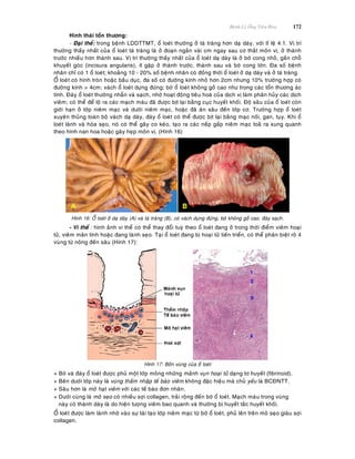 Beänh Lyù OÁng Tieâu Hoùa 172
Hình thaùi toån thöông:
- Ñaïi theå: trong beänh LDDTTMT, oå loeùt thöôøng ôû taù traøng hôn daï daøy, vôùi tæ leä 4:1. Vò trí
thöôøng thaáy nhaát cuûa oå loeùt taù traøng laø ôû ñoaïn ngaén vaøi cm ngay sau cô thaét moân vò, ôû thaønh
tröôùc nhieàu hôn thaønh sau. Vò trí thöôøng thaáy nhaát cuûa oå loeùt daï daøy laø ôû bôø cong nhoû, gaàn choã
khuyeát goùc (incisura angularis), ít gaëp ôû thaønh tröôùc, thaønh sau vaø bôø cong lôùn. Ña soá beänh
nhaân chæ coù 1 oå loeùt; khoaûng 10 - 20% soá beänh nhaân coù ñoàng thôøi oå loeùt ôû daï daøy vaø ôû taù traøng.
OÅ loeùt coù hình troøn hoaëc baàu duïc, ña soá coù ñöôøng kính nhoû hôn 2cm nhöng 10% tröôøng hôïp coù
ñöôøng kính > 4cm; vaùch oå loeùt döïng ñöùng; bôø oå loeùt khoâng goà cao nhö trong caùc toån thöông aùc
tính. Ñaùy oå loeùt thöôøng nhaün vaø saïch, nhôø hoaït ñoäng tieâu hoaù cuûa dòch vò laøm phaân huûy caùc dòch
vieâm; coù theå ñeå loä ra caùc maïch maùu ñaõ ñöôïc bòt laïi baèng cuïc huyeát khoái. Ñoä saâu cuûa oå loeùt coøn
giôùi haïn ôû lôùp nieâm maïc vaø döôùi nieâm maïc, hoaëc ñaõ aên saâu ñeán lôùp cô. Tröôøng hôïp oå loeùt
xuyeân thuûng toaøn boä vaùch daï daøy, ñaùy oå loeùt coù theå ñöôïc bòt laïi baèng maïc noái, gan, tuïy. Khi oå
loeùt laønh vaø hoùa seïo, noù coù theå gaây co keùo, taïo ra caùc neáp gaáp nieâm maïc toaû ra xung quanh
theo hình nan hoa hoaëc gaây heïp moân vò. (Hình 16)
Hình 16: OÅ loeùt ôû daï daøy (A) vaø taù traøng (B), coù vaùch döïng ñöùng, bôø khoâng goà cao, ñaùy saïch.
- Vi theå : hình aûnh vi theå coù theå thay ñoåi tuyø theo oå loeùt ñang ôû trong thôøi ñieåm vieâm hoaïi
töû, vieâm maõn tính hoaëc ñang laønh seïo. Taïi oå loeùt ñang bò hoaïi töû tieán trieån, coù theå phaân bieät roõ 4
vuøng töø noâng ñeán saâu (Hình 17):
Hình 17: Boán vuøng cuûa oå loeùt
+ Bôø vaø ñaùy oå loeùt ñöôïc phuû moät lôùp moûng nhöõng maûnh vuïn hoaïi töû daïng tô huyeát (fibrinoid).
+ Beân döôùi lôùp naøy laø vuøng thaám nhaäp teá baøo vieâm khoâng ñaëc hieäu maø chuû yeáu laø BCÑNTT.
+ Saâu hôn laø moâ haït vieâm vôùi caùc teá baøo ñôn nhaân.
+ Döôùi cuøng laø moâ seïo coù nhieàu sôïi collagen, traûi roäng ñeán bôø oå loeùt. Maïch maùu trong vuøng
naøy coù thaønh daøy laø do hieän töôïng vieâm bao quanh vaø thöôøng bò huyeát taéc huyeát khoái.
OÅ loeùt ñöôïc laøm laønh nhôø vaøo söï taùi taïo lôùp nieâm maïc töø bôø oå loeùt, phuû leân treân moâ seïo giaøu sôïi
collagen.
 