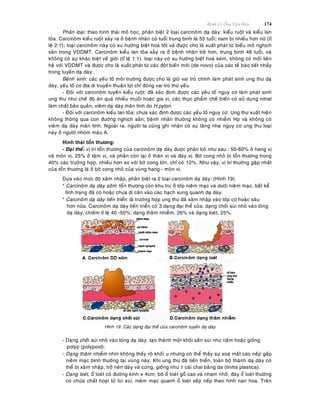 Beänh Lyù OÁng Tieâu Hoùa 174
Phaân loaïi: theo hình thaùi moâ hoïc, phaân bieät 2 loaïi carcinoâm daï daøy: kieåu ruoät vaø kieåu lan
toûa. Carcinoâm kieåu ruoät xaûy ra ôû beänh nhaân coù tuoåi trung bình laø 55 tuoåi; nam bò nhieàu hôn nöõ (tæ
leä 2:1)õ; loaïi carcinoâm naøy coù xu höôùng bieät hoaù toát vaø ñöôïc cho laø xuaát phaùt töø bieåu moâ nghòch
saûn trong VDDMT. Carcinoâm kieåu lan toûa xaûy ra ôû beänh nhaân treû hôn, trung bình 48 tuoåi, vaø
khoâng coù söï khaùc bieät veà giôùi (tæ leä 1:1). loaïi naøy coù xu höôùng bieät hoaù keùm, khoâng coù moái lieân
heä vôùi VDDMT vaø ñöôïc cho laø xuaát phaùt töø caùc ñoät bieán môùi (de novo) cuûa caùc teá baøo tieát nhaày
trong tuyeán daï daøy.
Beänh sinh: caùc yeáu toá moâi tröôøng ñöôïc cho laø giöõ vai troø chính laøm phaùt sinh ung thö daï
daøy, yeáu toá cô ñòa di truyeàn thuaän lôïi chæ ñoùng vai troø thöù yeáu.
- Ñoái vôùi carcinoâm tuyeán kieåu ruoät: ñaõ xaùc ñònh ñöôïc caùc yeáu toá nguy cô laøm phaùt sinh
ung thö nhö cheá ñoä aên quaù nhieàu muoái hoaëc gia vò, caùc thöïc phaåm cheá bieán coù söû duïng nitrat
laøm chaát baûo quaûn; vieâm daï daøy maõn tính do H.pylori.
- Ñoái vôùi carcinoâm kieåu lan toûa: chöa xaùc ñònh ñöôïc caùc yeáu toá nguy cô. Ung thö xuaát hieän
khoâng thoâng qua con ñöôøng nghòch saûn; beänh nhaân thöôøng khoâng coù nhieãm Hp vaø khoâng coù
vieâm daï daøy maõn tính. Ngoaøi ra, ngöôøi ta cuõng ghi nhaän coù söï taêng nheï nguy cô ung thö loaïi
naøy ôû ngöôøi nhoùm maùu A.
Hình thaùi toån thöông:
- Ñaïi theå: vò trí toån thöông cuûa carcinoâm daï daøy ñöôïc phaân boá nhö sau : 50-60% ôû hang vò
vaø moân vò, 25% ôû taâm vò, vaø phaàn coøn laïi ôû thaân vò vaø ñaùy vò. Bôø cong nhoû bò toån thöông trong
40% caùc tröôøng hôïp, nhieàu hôn so vôùi bôø cong lôùn, chæ coùø 12%. Nhö vaäy, vò trí thöôøng gaëp nhaát
cuûa toån thöông laø ôû bôø cong nhoû cuûa vuøng hang - moân vò.
Döïa vaøo möùc ñoä xaâm nhaäp, phaân bieät ra 2 loaïi carcinoâm daï daøy: (Hình 19)
* Carcinoâm daï daøy sôùm: toån thöông coøn khu truù ôû lôùp nieâm maïc vaø döôùi nieâm maïc, baát keå
tình traïng ñaõ coù hoaëc chöa di caên vaøo caùc haïch xung quanh daï daøy.
* Carcinoâm daï daøy tieán trieån: laø tröôøng hôïp ung thö ñaõ xaâm nhaäp vaøo lôùp cô hoaëc saâu
hôn nöõa. Carcinoâm daï daøy tieán trieån coù 3 daïng ñaïi theå cuûa: daïng choài suøi nhoâ vaøo loøng
daï daøy, chieám tæ leä 40 -50%; daïng thaâm nhieãm, 26% vaø daïng loeùt, 25%.
Hình 19: Caùc daïng ñaïi theå cuûa carcinoâm tuyeán daï daøy
- Daïng choài suøi nhoâ vaøo loøng daï daøy, taïo thaønh moät khoái saàn suøi nhö naám hoaëc gioáng
polyùp (polypoid).
- Daïng thaâm nhieãm nhìn khoâng thaáy roõ khoái u nhöng coù theå thaáy söï xoaù maát caùc neáp gaáp
nieâm maïc bình thöôøng taïi vuøng naøy. Khi ung thö ñaõ tieán trieån, toaøn boä thaønh daï daøy coù
theå bò xaâm nhaäp, trôû neân daøy vaø cöùng, gioáng nhö 1 caùi chai baèng da (linitis plastica).
- Daïng loeùt, oå loeùt coù ñöôøng kính > 4cm, bôø oå loeùt goà cao vaø nham nhôû, ñaùy oå loeùt thöôøng
coù chöùa chaát hoaïi töû luøi xuøi, nieâm maïc quanh oå loeùt xeáp neáp theo hình nan hoa. Treân
 