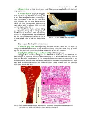 Beänh Lyù OÁng Tieâu Hoùa 176
3.Thoaùt vò roán: laø söï thoaùt vò ruoät non ra ngoaøi oå buïng, do söï suy yeáu baåm sinh cuûa thaønh
buïng quanh roán.
4. Tuùi thöøa Meckel: dò daïng thöôøng gaëp
nhaát, xaûy ra do oáng maïc treo - roán khoâng teo
laïi, taïo thaønh 1 oáng bòt coù chieàu daøi khoaûng 5-
6 cm, ñöôøng kính coù theå ñaït gaàn baèng kích
thöôùc cuûa ruoät non. Tuùi thöøa Meckel thöôøng
thaáy ôû hoài traøng (trong khoaûng 85cm tính töø
manh traøng), vaùch coù caáu taïo 4 lôùp nhö ruoät
non bình thöôøng (Hình 21)
Tuùi thöøa Meckel thöôøng voâ haïi, khoâng
gaây trieäu chöùng. Trong moät soá tröôøng hôïp, tuùi
thöøa Meckel coù chöùa moät oå nieâm maïc daï daøy
laïc choã, coù theå gaây loeùt nieâm maïc ruoät keá caän
ñöa ñeán xuaát huyeát tieâu hoùa. Moâ tuïy laïc choã ôû
tuùi thöøa Meckel cuõng coù theå gaëp nhöng hieám
hôn.
Hình 21 : Tuùi thöøa Meckel, daïng oáng bòt nhoû.
ÔÛ ñaïi traøng, coù 2 dò daïng baåm sinh chính sau:
5. Quai ruoät quay chöa heát trong thôøi kyø phaùt trieån phoâi thai, khieán cho caùc ñoaïn ruoät
khoâng ñöôïc saép xeáp vaøo ñuùng vò trí bình thöôøng cuûa chuùng.Thí duï nhö manh traøng laïi naèm ôû
goùc treân phaûi hoaëc treân traùi cuûa oå buïng. Loaïi dò daïng naøy deã daãn ñeán xoaén ruoät.
6. Beänh phình giaõn ñaïi traøng voâ haïch baåm sinh (beänh Hirschsprung):
Trong giai ñoaïn phoâi thai, caùc nguyeân baøo thaàn kinh seõ di chuyeån töø maøo thaàn kinh ñeán
thaønh ruoät giaø ñeå taïo thaønh ñaùm roái Auerbach trong lôùp cô vaø ñaùm roái Meissner trong lôùp döôùi
nieâm maïc. Khi söï di chuyeån naøy bò öùc cheá, moät ñoaïn ruoät voâ haïch seõ ñöôïc hình thaønh vaø gaây
taéc ruoät cô naêng; phaàn ñaïi traøng ôû phía treân ñoaïn ruoät voâ haïch seõ bò phình giaõn daàn do öù ñoïng
phaân. Xuaát ñoä beänh Hirschsprung vaøo khoaûng 1/5000 – 1/8000 treû sinh soáng, giôùi nam maéc
beänh nhieàu hôn nöõ (tæ leä 4:1).
Hình 22: Phaàn ruoät treân ñoaïn voâ haïch bò phình giaõn (A), thaønh ñoaïn ruoät voâ haïch coù sôïi thaàn kinh (C)
nhöng khoâng coù teá baøo haïch thaàn kinh nhö ôû ngöôøi bình thöôøng (B)
 