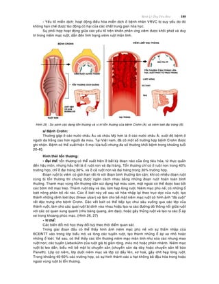 Beänh Lyù OÁng Tieâu Hoùa 180
- Yeáu toá mieãn dòch: hoaït ñoäng ñieàu hoøa mieãn dòch ôû beänh nhaân VRVC bò suy yeáu do ñoù
khoâng haïn cheá ñöôïc taùc ñoäng coù haïi cuûa caùc chaát trung gian hoùa hoïc.
Söï phoái hôïp hoaït ñoäng giöõa caùc yeáu toá treân khieán phaûn öùng vieâm ñöôïc khôûi phaùt vaø duy
trì trong nieâm maïc ruoät, daãn ñeán tình traïng vieâm ruoät maõn tính.
Hình 26 : So saùnh caùc daïng toån thöông vaø vò trí toån thöông cuûa beänh Crohn (A) vaø vieâm loeùt ñaïi traøng (B)
a/ Beänh Crohn:
Thöôøng gaëp ôû caùc nöôùc chaâu AÂu vaø chaâu Myõ hôn laø ôû caùc nöôùc chaâu AÙ; xuaát ñoä beänh ôû
ngöôøi da traéng cao hôn ngöôøi da maøu. Taïi Vieät nam, ñaõ coù moät soá tröôøng hôïp beänh Crohn ñöôïc
ghi nhaän. Beänh coù theå xuaát hieän ôû moïi löùa tuoåi nhöng ña soá thöôøng khôûi beänh trong khoaûng tuoåi
20-40.
Hình thaùi toån thöông:
- Ñaïi theå: toån thöông coù theå xuaát hieän ôû baát kyø ñoaïn naøo cuûa oáng tieâu hoùa, töø thöïc quaûn
ñeán haäu moân, nhöng haàu heát laø ôû ruoät non vaø ñaïi traøng. Toån thöông chæ coù ôû ruoät non trong 40%
tröôøng hôïp, chæ ôû ñaïi traøng 30%, vaø ôû caû ruoät non vaø ñaïi traøng trong 30% tröôøng hôïp.
Ñoaïn ruoät bò vieâm coù giôùi haïn raát roõ vôùi ñoaïn bình thöôøng laân caän; khi coù nhieàu ñoaïn ruoät
cuøng bò toån thöông thì chuùng ñöôïc ngaên caùch nhau baèng nhöõng ñoaïn ruoät hoaøn toaøn bình
thöôøng. Thanh maïc vuøng toån thöông saàn suøi daïng haït maøu xaùm, maët ngoaøi coù theå ñöôïc bao bôûi
caùc bôøm môõ maïc treo. Thaønh ruoät daøy vaø dai, laøm heïp loøng ruoät. Nieâm maïc phuø neà, coù nhöõng oå
loeùt noâng phaân boá raûi raùc. Caùc oå loeùt naøy veà sau seõ hoøa nhaäp laïi theo truïc doïc cuûa ruoät, taïo
thaønh nhöõng raõnh loeùt doïc (linear ulcer) vaø laøm cho beà maët nieâm maïc ruoät coù hình aûnh "ñaù cuoäi"
raát ñaëc tröng cho beänh Crohn. Caùc veát loeùt coù theå tieáp tuïc chui saâu xuoáng qua caùc lôùp cuûa
thaønh ruoät, laøm cho caùc quai ruoät bò dính vaøo nhau hoaëc taïo ra caùc ñöôøng doø thoâng noái giöõa ruoät
vôùi caùc cô quan xung quanh (nhö baøng quang, aâm ñaïo), hoaëc gaây thuûng ruoät vaø taïo ra caùc oå aùp
xe trong khoang phuùc maïc. (Hình 26, 27)
- Vi theå:
Caùc bieán ñoåi moâ hoïc thay ñoåi tuyø theo thôøi ñieåm quan saùt.
Trong giai ñoaïn ñaàu coù theå thaáy hình aûnh nieâm maïc phuø neà vôùi söï thaám nhaäp cuûa
BCÑNTT vaøo trong lôùp bieåu moâ vaø loøng caùc tuyeán ruoät, taïo thaønh nhöõng oå aùp xe nhoû hoaëc
nhöõng oå loeùt. Veà sau, coù theå thaáy caùc toån thöông nieâm maïc maõn tính nhö xoùa caùc nhung mao
ruoät non; caùc tuyeán Lieberkühn cuûa ruoät giaø bò giaõn roäng, meùo moù hoaëc phaân nhaùnh. Nieâm maïc
ruoät bò teo daàn, bieåu moâ beà maët bò chuyeån saûn (chuyeån saûn daï daøy hoaëc chuyeån saûn teá baøo
Paneth). Lôùp cô nieâm, lôùp döôùi nieâm maïc vaø lôùp cô daày leân, xô hoaù, gaây chít heïp loøng ruoät.
Trong khoaûng 40-60% caùc tröôøng hôïp, coù söï hình thaønh caùc u haït khoâng baõ ñaäu hoùa trong hoaëc
ngoaøi vuøng ruoät bò toån thöông.
 