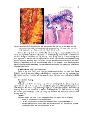 Beänh Lyù OÁng Tieâu Hoùa 181
Hình 27: Beänh Crohn ôû hoài traøng, thaønh ruoät daày, heïp loøng ruoät, nieâm maïc hình ñaù cuoäi vaø caùc raõnh loeùt
doïc (muõi teân), maët ngoaøi thanh maïc coù bôøm môõ maïc treo baùm (A); Treân vi theå , nieâm maïc thaám
nhaäp teá baøo vieâm, coù 2 oå loeùt trong ñoù moät oå ñi saâu ñeán lôùp cô (B).
Lieân heä laâm saøng: Beänh nhaân bò nhöõng ñôït soát, ñau buïng, tieâu chaûy hoaëc tieâu ra maùu xen
keõ vôùi giai ñoaïn khoâng bieåu hieän trieäu chöùng keùo daøi haøng thaùng. Veà sau coù theå xuaát hieän theâm
caùc trieäu chöùng do bieán chöùng taéc ruoät, doø ruoät - baøng quang hoaëc aùp xe trong khoang phuùc
maïc. Ngoaøi ra, coù theå thaáy trieäu chöùng cuûa caùc toån thöông ngoaøi ruoät nhö vieâm ña khôùp, hoàng
ban noát, ngoùn tay duøi troáng. Nguy cô ung thö ruoät gia taêng tæ leä thuaän vôùi thôøi gian maéc beänh,
khoaûng 5% beänh nhaân seõ bò ung thö ruoät sau khi beänh ñaõ keùo daøi treân 7 naêm. Ñieàu trò bao goàm
vieäc söû duïng caùc thuoác khaùng vieâm, öùc cheá mieãn dòch keát hôïp vôùi can thieäp ngoaïi khoa ñeå giaûi
quyeát caùc bieán chöùng.
b. Vieâm loeùt ñaïi traøng (ulcerative colitis):
Töông töï nhö beänh Crohn, beänh vieâm loeùt ñaïi traøng thöôøng gaëp ôû caùc nöôùc Chaâu AÂu vaø
Chaâu Myõ hôn laø ôû caùc nöôùc chaâu AÙ; xuaát ñoä beänh ôû ngöôøi da traéng cao hôn ngöôøi da maøu.
Beänh coù theå xuaát hieän ôû moïi löùa tuoåi nhöng ña soá thöôøng khôûi beänh trong khoaûng tuoåi töø 20-25
tuoåi.
Hình thaùi toån thöông:
- Ñaïi theå:
Khaùc vôùi beänh Crohn, toån thöông trong vieâm loeùt ñaïi traøng khôûi ñaàu ôû tröïc traøng roài lan
ngöôïc leân daàn moät caùch lieân tuïc, coù khi toaøn boä khung ñaïi traøng; khoâng coù nhöõng ñoaïn ruoät
laønh chen giöõa. Nieâm maïc vuøng toån thöông sung huyeát ñoû, deã bò bong troùc taïo thaønh nhöõng oå
loeùt roäng. Treân neàn loeùt xuaát huyeát, coù theå thaáy hoaït ñoäng taùi taïo cuûa nieâm maïc taïo neân nhöõng
noát choài leân gioáng nhö polyùp. Thaønh ruoät khoâng daày leân vaø beà maët thanh maïc hoaøn toaøn bình
thöôøng. (Hình 28)
- Vi theå:
Caùc bieán ñoåi moâ hoïc töông töï nhö trong beänh Crohn, chæ khaùc ôû moät soá ñieåm sau:
+ Khoâng coù hình thaønh u haït trong thaønh ruoät.
+ Caùc veát loeùt nieâm maïc chæ lan xuoáng döôùi nieâm maïc, khoâng phaù huûy lôùp cô.
+ Khi beänh vaøo giai ñoaïn thuyeân giaûm, veát loeùt seõ ñöôïc laáp ñaày baèng moâ haït vieâm vaø
hoùa seïo, lôùp nieâm maïc beân treân laïi ñöôïc taùi taïo.
 