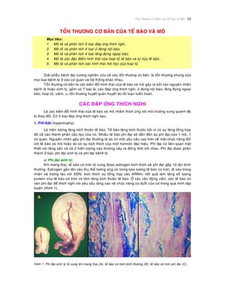 Toån Thöông Cô Baûn cuûa Teá baøo vaø Moâ 11
TOÅN THÖÔNG CÔ BAÛN CUÛA TEÁ BAØO VAØ MOÂ
Muïc tieâu:
1. Moâ taû vaø phaân tích 5 loaïi ñaùp öùng thích nghi.
2. Moâ taû vaø phaân tích 4 loaïi öù ñoïng noäi baøo.
3. Moâ taû vaø phaân tích 4 loaïi laéng ñoïng ngoaïi baøo.
4. Moâ taû caùc ñaëc ñieåm hình thaùi cuûa hoaïi töû teá baøo vaø töï huûy teá baøo. .
5. Moâ taû vaø phaân tích caùc hình thaùi moâ hoïc cuûa hoaïi töû.
Giaûi phaãu beänh ñaïi cöông nghieân cöùu veà caùc toån thöông cô baûn, laø toån thöông chung cuûa
moïi loaïi beänh lyù ôû caùc cô quan vaø heä thoáng khaùc nhau.
Toån thöông cô baûn laø caùc bieán ñoåi hình thaùi cuûa teá baøo vaø moâ gaây ra bôûi caùc nguyeân nhaân
beänh lyù hoaëc sinh lyù, goàm coù 7 loaïi laø: caùc ñaùp öùng thích nghi, öù ñoïng noäi baøo, laéng ñoïng ngoaïi
baøo, hoaïi töû, vieâm, u, toån thöông huyeát quaûn huyeát do roái loaïn tuaàn hoaøn.
CAÙC ÑAÙP ÖÙNG THÍCH NGHI
Laø caùc bieán ñoåi hình thaùi cuûa teá baøo vaø moâ nhaèm thích öùng vôùi moâi tröôøng xung quanh ñaõ
bò thay ñoåi. Coù 5 loaïi ñaùp öùng thích nghi sau:
1. PHÌ ÑAÏI (hypertrophy)
Laø hieän töôïng taêng kích thöôùc teá baøo. Teá baøo taêng kích thöôùc bôûi vì coù söï taêng toång hôïp
taát caû caùc thaønh phaàn caáu taïo cuûa noù. Nhieàu teá baøo phì ñaïi seõ daãn ñeán söï phì ñaïi cuûa 1 moâ, 1
cô quan. Nguyeân nhaân gaây phì ñaïi thöôøng laø do coù moät yeâu caàu cao hôn veà maët chöùc naêng ñoái
vôùi teá baøo vaø moâ hoaëc do coù söï kích thích cuûa moät hormoân ñaëc hieäu. Phì ñaïi coù lieân quan maät
thieát vôùi taêng saûn vaø caû 2 hieän töôïng naøy thöôøng xaûy ra ñoàng thôøi vôùi nhau. Phì ñaïi ñöôïc phaân
thaønh 2 loaïi: phì ñaïi sinh lyù vaø phì ñaïi beänh lyù.
a/ Phì ñaïi sinh lyù:
Khi mang thai, teá baøo cô trôn töû cung ñöôïc estrogen kích thích seõ phì ñaïi gaáp 10 laàn bình
thöôøng. Estrogen gaén leân caùc thuï theå töông öùng coù trong baøo töông teá baøo cô trôn, ñi vaøo trong
nhaân vaø töông taùc vôùi ADN, kích thích söï toång hôïp caùc ARNm; keát quaû laøm taêng soá löôïng
protein cuûa teá baøo cô trôn vaø laøm taêng kích thöôùc teá baøo. ÔÛ caùc vaän ñoäng vieân, caùc teá baøo cô
vaân phì ñaïi ñeå thích nghi vôùi yeâu caàu taêng cao veà chöùc naêng co duoãi cuûa cô trong quaù trình taäp
luyeän (Hình 1).
Hình 1: Phì ñaïi sinh lyù töû cung khi mang thai (A); teá baøo cô trôn bình thöôøng (B); teá baøo cô trôn phì ñaïi (C).
 