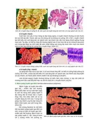 Beänh Lyù OÁng Tieâu Hoùa 184
Hình 30: U tuyeán oáng coù cuoáng (A, B), beân caïnh caùc tuyeán taêng saûn laønh tính, coù vuøng nghòch saûn nheï (C) .
b/ U tuyeán nhaùnh:
Xuaát hieän chuû yeáu ôû tröïc traøng vaø ñaïi traøng sigma. U tuyeán nhaùnh thöôøng coù kích thöôùc
lôùn (coù theå ñaït ñeán 10cm), saàn suøi nhö boâng caûi vaø khoâng coù cuoáng. Veà vi theå, u tuyeán nhaùnh
taïo bôûi bieåu moâ ruoät taêng saûn vaø nghòch saûn, taïo thaønh caùc caáu truùc daïng nhaùnh gioáng nhung
mao ruoät. Taïi ñaây, coù theå tìm thaáy toån thöông nghòch saûn ôû moïi möùc ñoä vaø caû nhöõng oå carcinoâm
coøn trong giai ñoaïn taïi choã hoaëc ñaõ xaâm nhaäp thaúng vaøo trong lôùp döôùi nieâm maïc cuûa thaønh
ruoät (vì loaïi naøy khoâng coù cuoáng nhö u tuyeán oáng). (Hình 31)
Hình 31: U tuyeán nhaùnh khoâng cuoáng (A,B), caïnh caùc tuyeán taêng saûn laønh tính, coù vuøng nghòch saûn nheï (C).
c/ U tuyeán oáng - nhaùnh:
Laø daïng hoãn hôïp cuûa 2 loaïi treân. U coù kích thöôùc thay ñoåi, coù theå coù cuoáng hoaëc khoâng coù
cuoáng. Veà vi theå, u ñöôïc taïo bôûi bieåu moâ ruoät taêng saûn vaø nghòch saûn, taïo thaønh caùc oáng tuyeán
vaø caùc nhaùnh, vôùi thaønh phaàn nhaùnh chieám tæ leä vaøo khoaûng töø 25-50% .
Lieân heä laâm saøng:U tuyeán thöôøng khoâng coù bieåu hieän trieäu chöùng, vì vaäy caàn phaûi coù
chöông trình taàm soaùt ñeå phaùt hieän vaø caét boû tröôùc khi u chuyeån thaønh ung thö.
3. Beänh polyùp tuyeán gia ñình (familial adenomatous polyposis):
Beänh ít gaëp, di truyeàn treân kieåu
gen troäi - nhieãm saéc theå thöôøng.
Beänh bieåu hieän vôùi söï xuaát hieän ngay
töø tuoåi treû haøng traêm polyùp tuyeán ôû
ñaïi traøng (ña soá thuoäc loaïi u tuyeán
oáng); haàu nhö chaéc chaén seõ coù söï
chuyeån daïng aùc tính cuûa 1 trong caùc
polyùp naøy thaønh ung thö ñaïi traøng khi
beänh nhaân böôùc vaøo tuoåi trung nieân.
(Hình 32)
Hoäi chöùng Gardner laø moät bieán
theå cuûa beänh polyùp tuyeán gia ñình noùi
treân, cuõng coù kieåu di truyeàn gen troäi -
nhieãm saéc theå thöôøng. Beänh nhaân coù
caùc polyùp tuyeán ôû ñaïi traøng ñi keøm
vôùi u xöông nhieàu nôi (xöông soï,
Hình 32: Beänh polyùp tuyeán gia ñình, nieâm maïc coù voâ soá polyùp
 